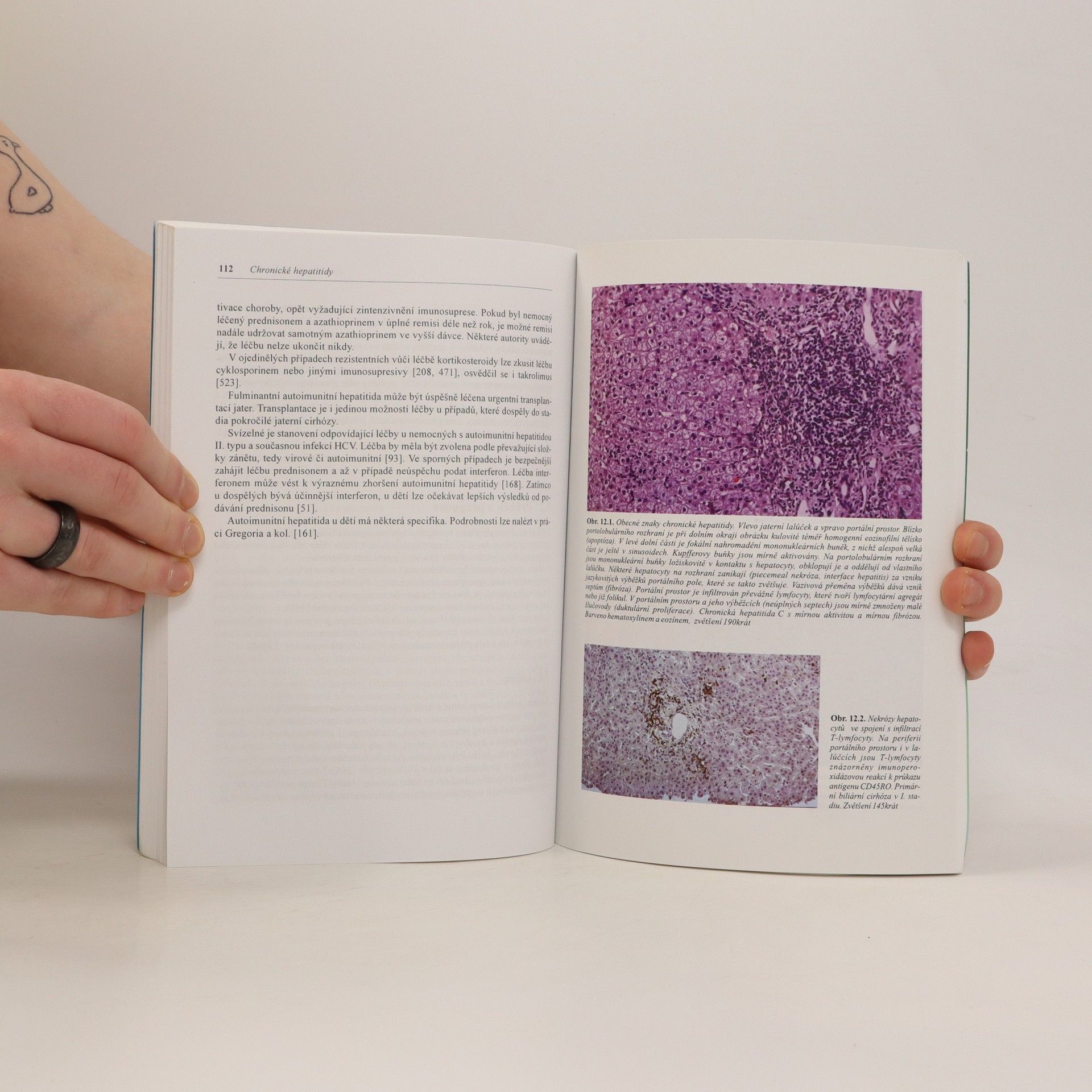 Jan Stříteský Chronické hepatitidy