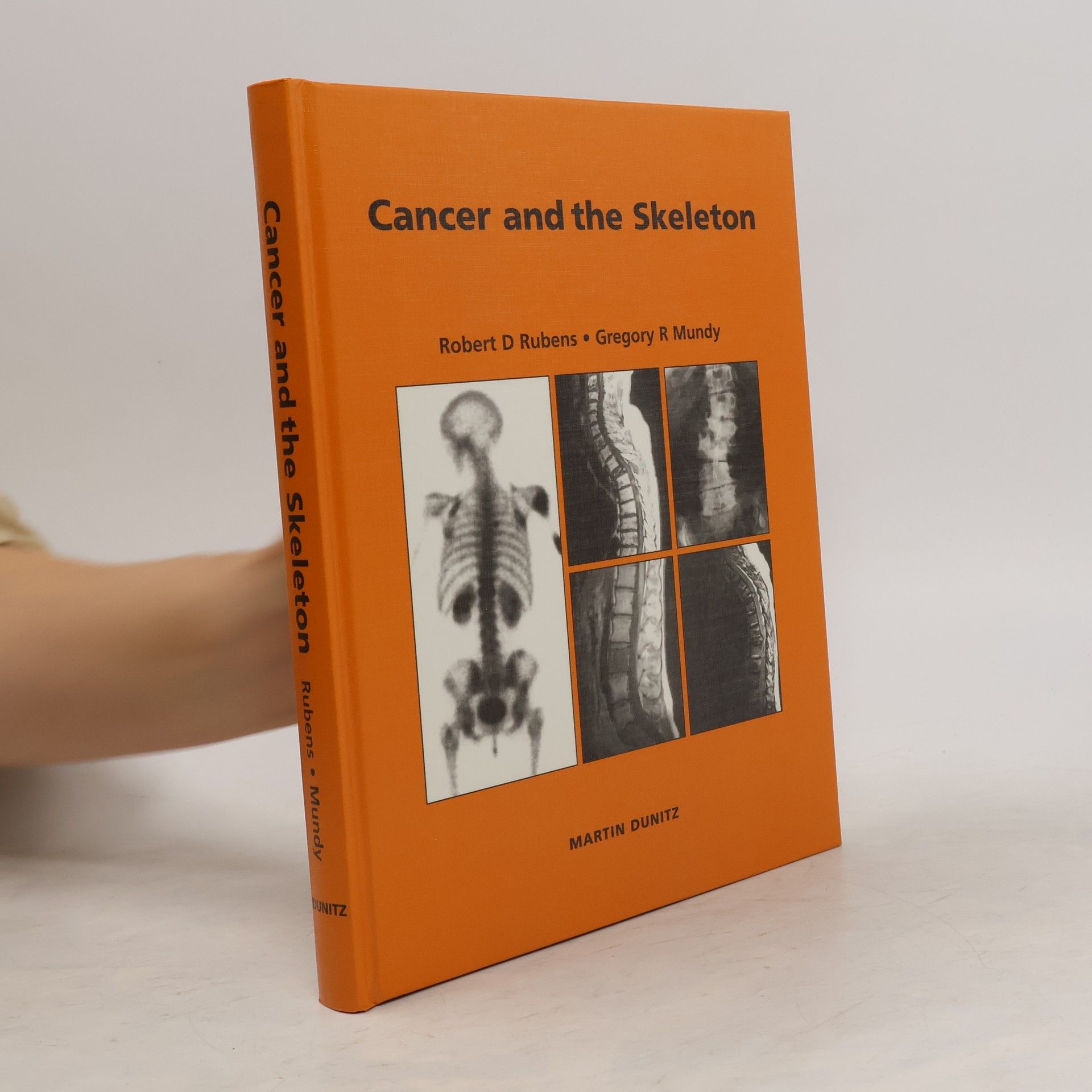 Gregory R. Mundy Cancer and the skeleton