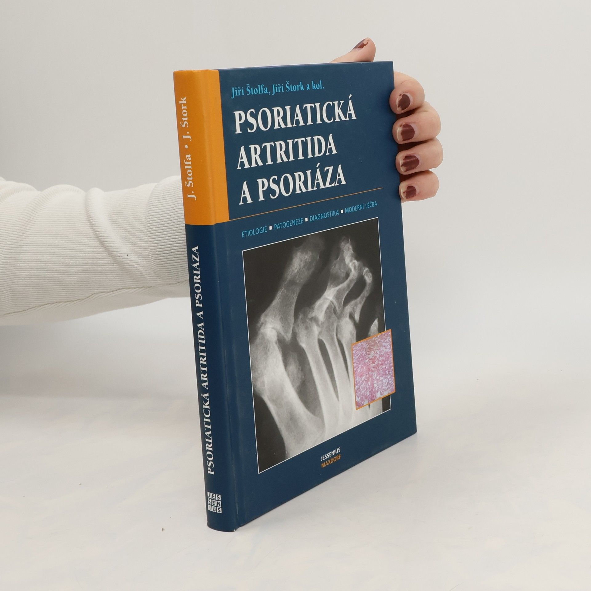 Jiří Štolfa Psoriatická artritida a psoriáza. Etiologie, patogeneze, diagnostika, moderní léčba