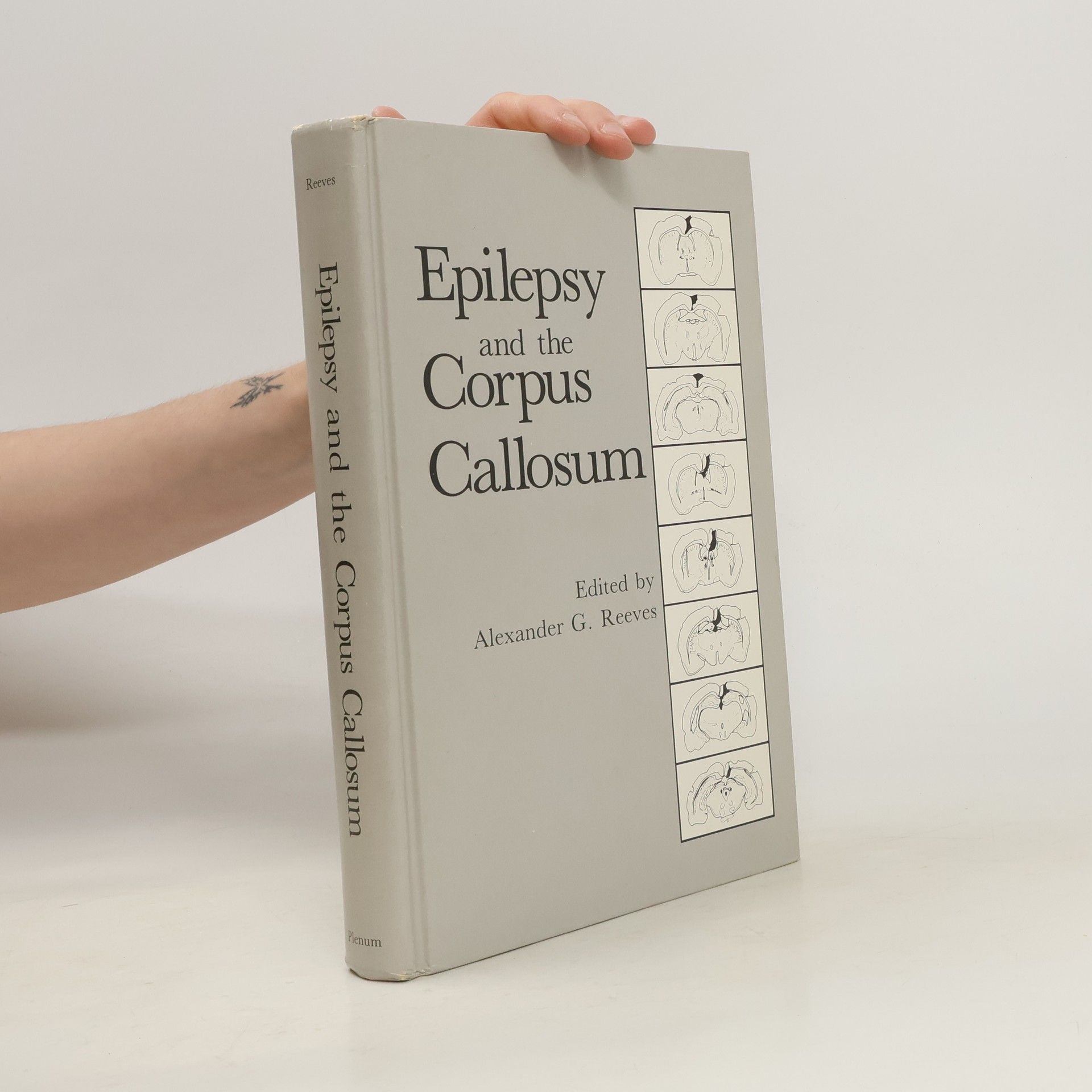 Alexander G. Reeves Epilepsy and the Corpus Callosum