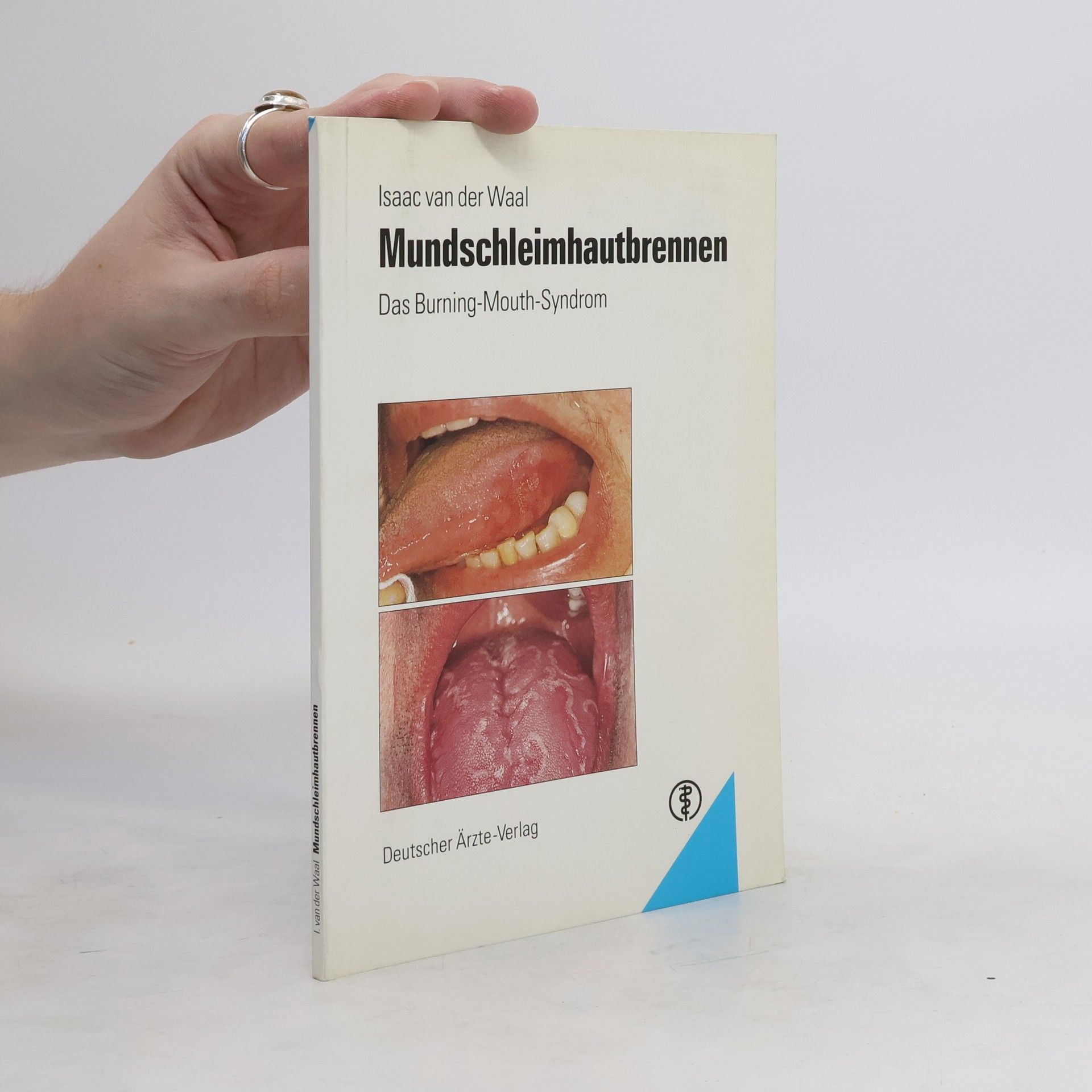 Isaäc van der Waal Mundschleimhautbrennen