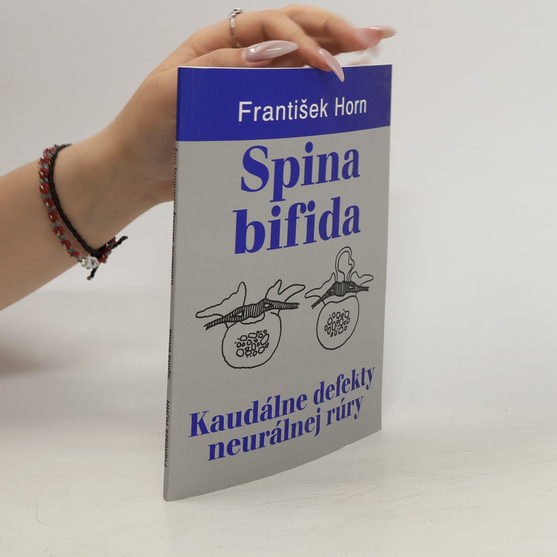 František Horn Spina bifida : kaudálne defekty neurálnej rúry