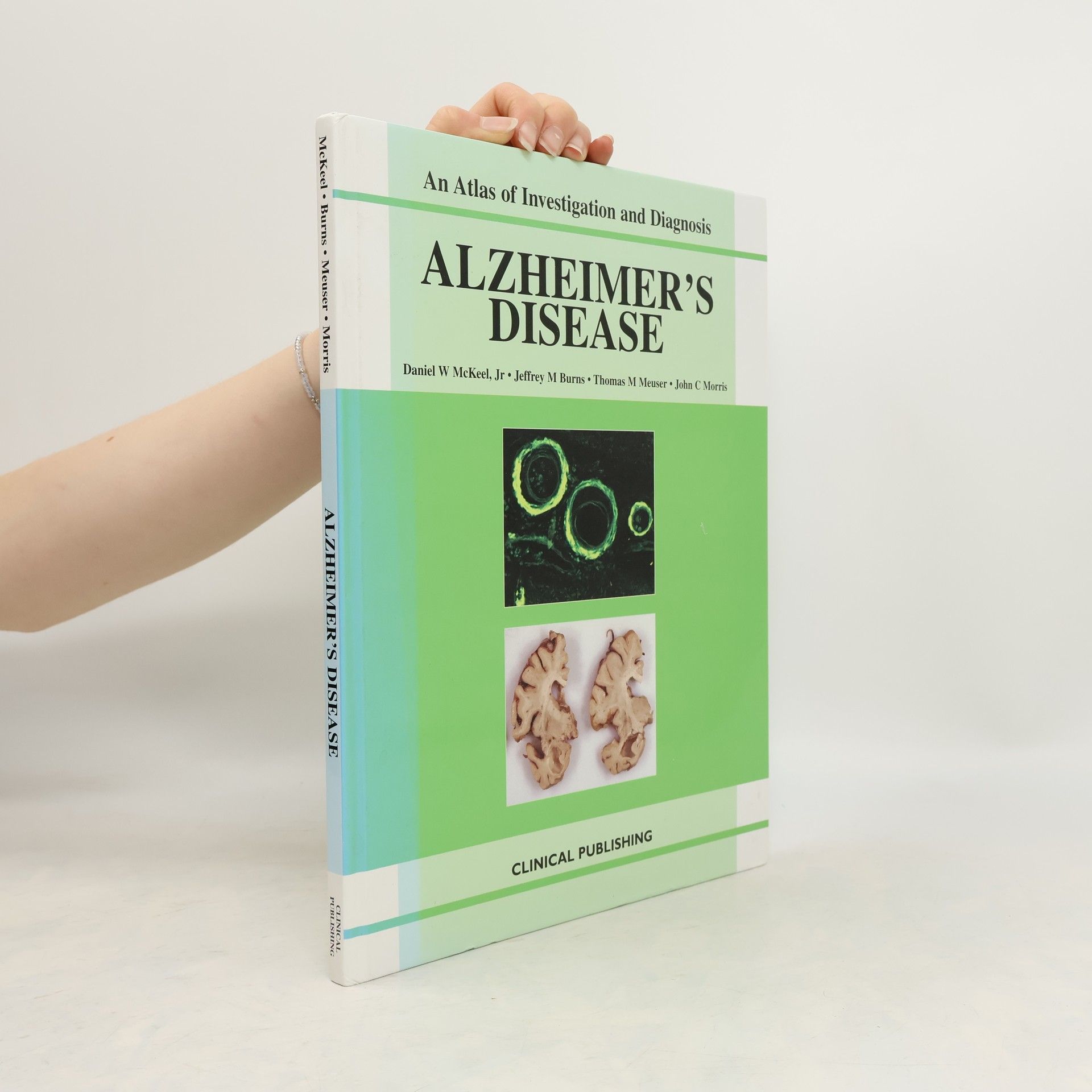 Alzheimer's Disease
