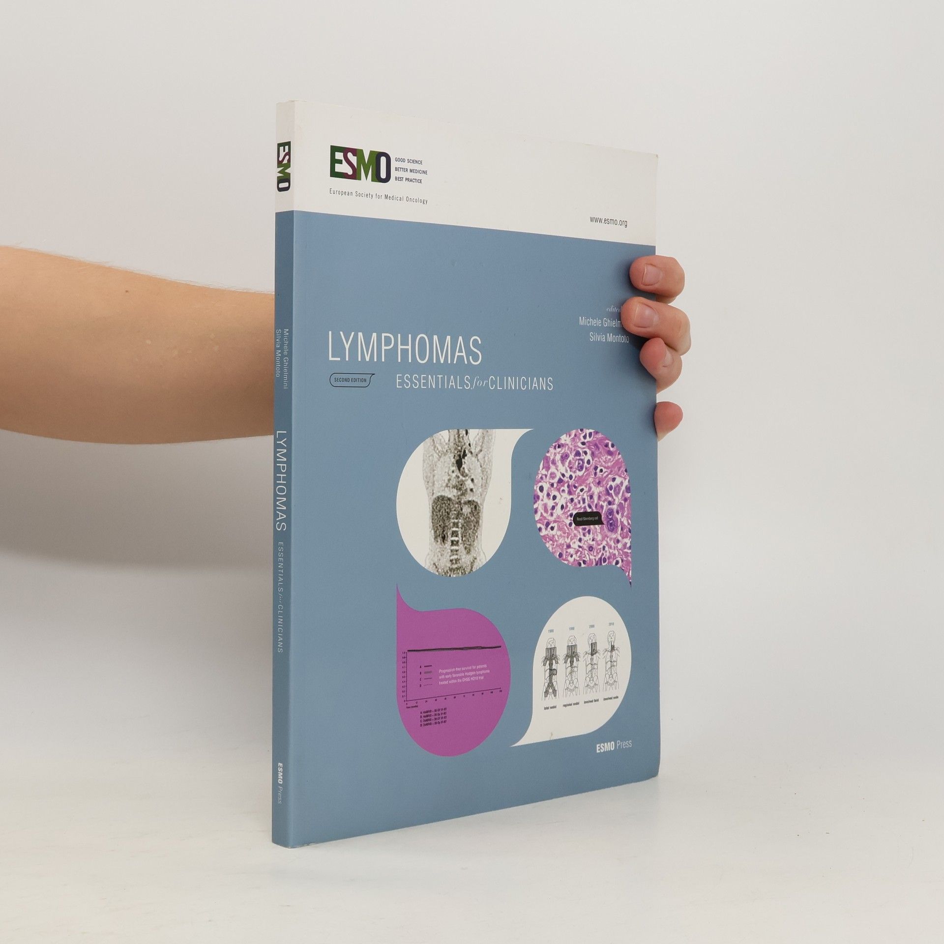 Silvia Montoto Lymphomas