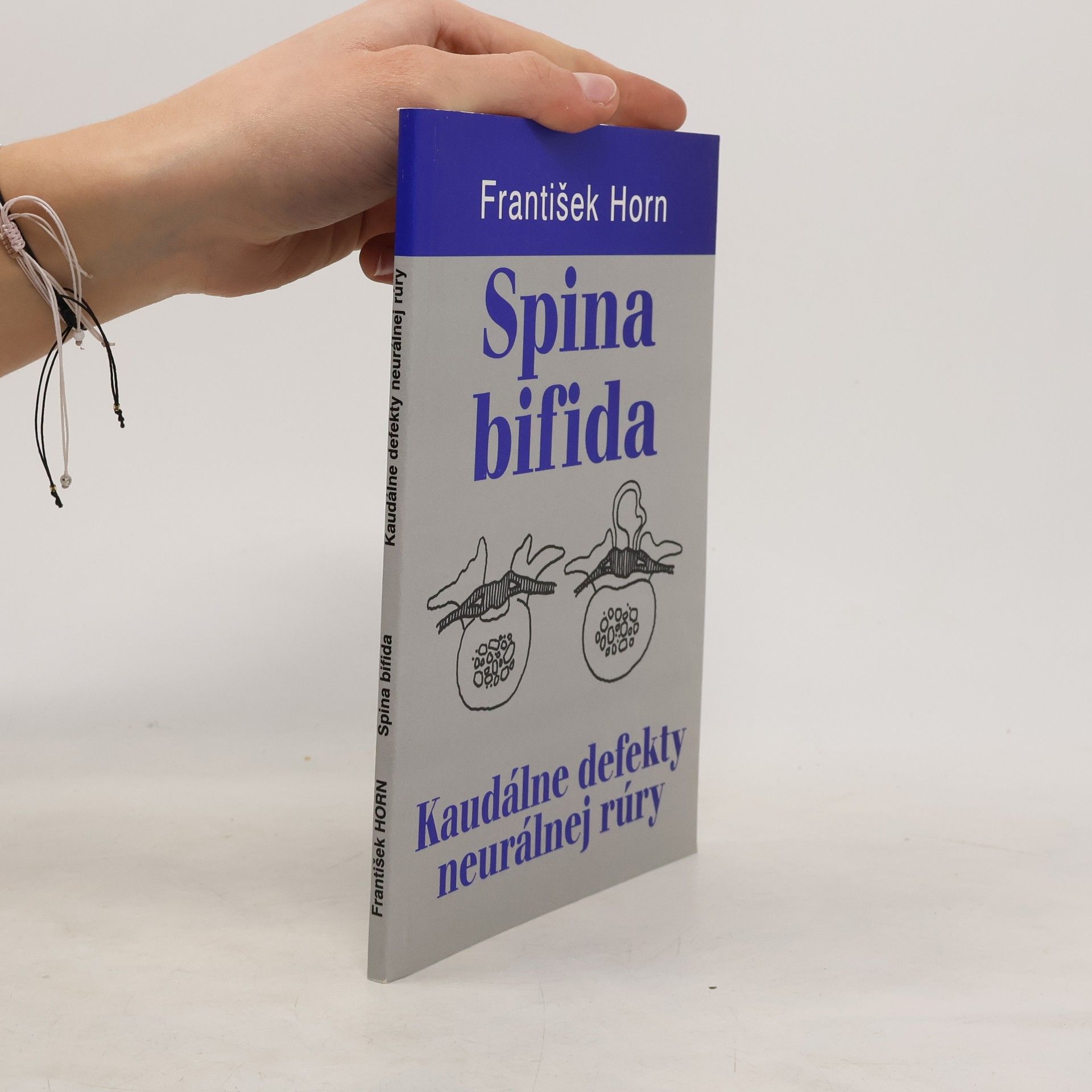 Spina bifida : kaudálne defekty neurálnej rúry