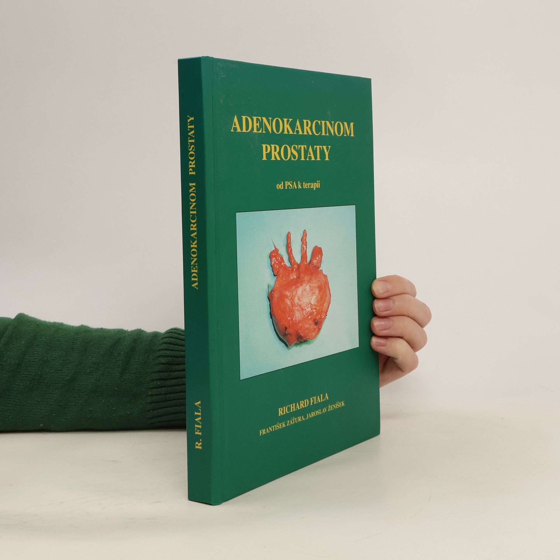 Adenokarcinom prostaty od PSA k terapii