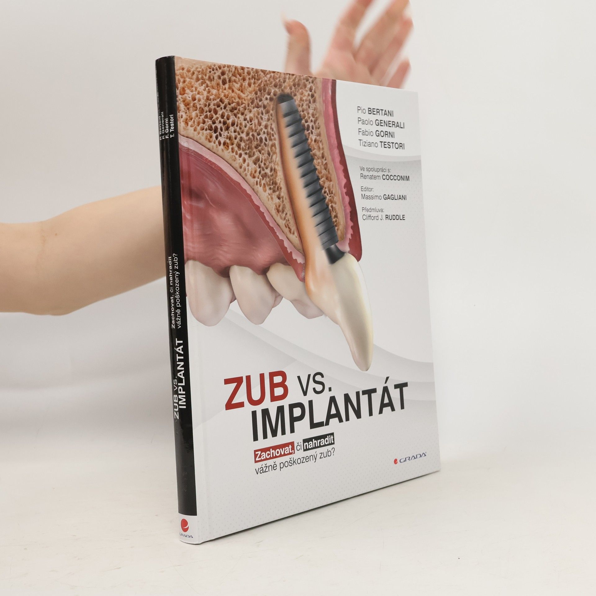 Pio Bertani Zub vs. implantát