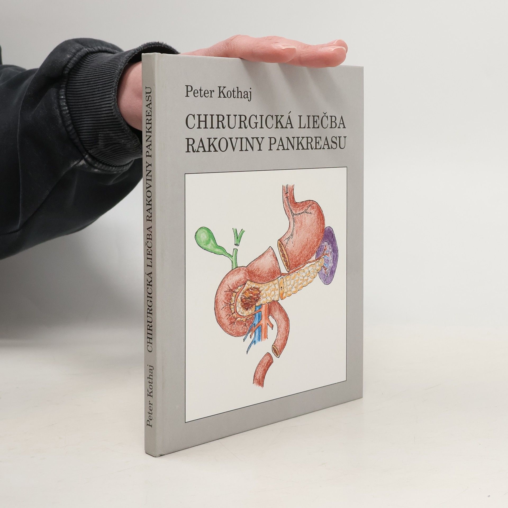 Chirurgická liečba rakoviny pankreasu