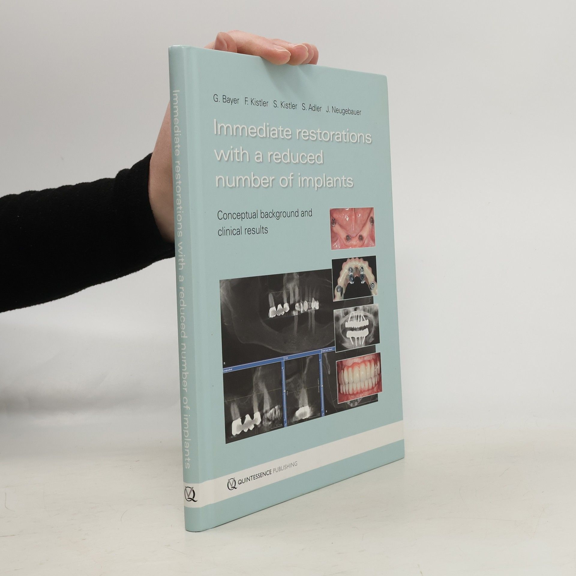 Georg Bayer Immediate Restorations with a Reduced Number of Implants