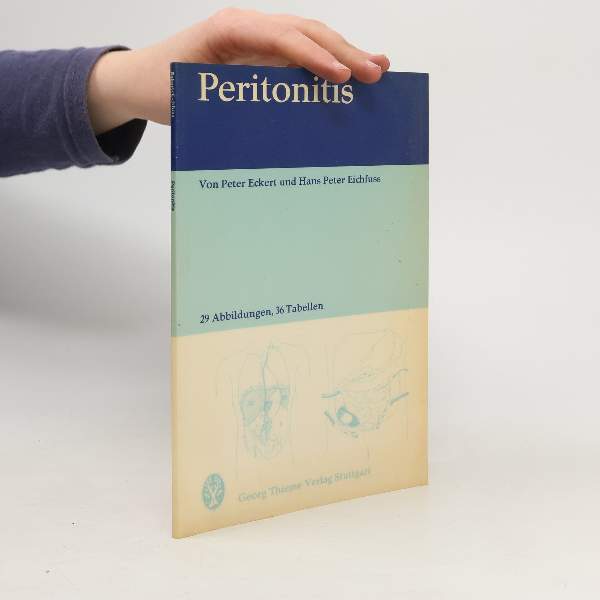 Peritonitis