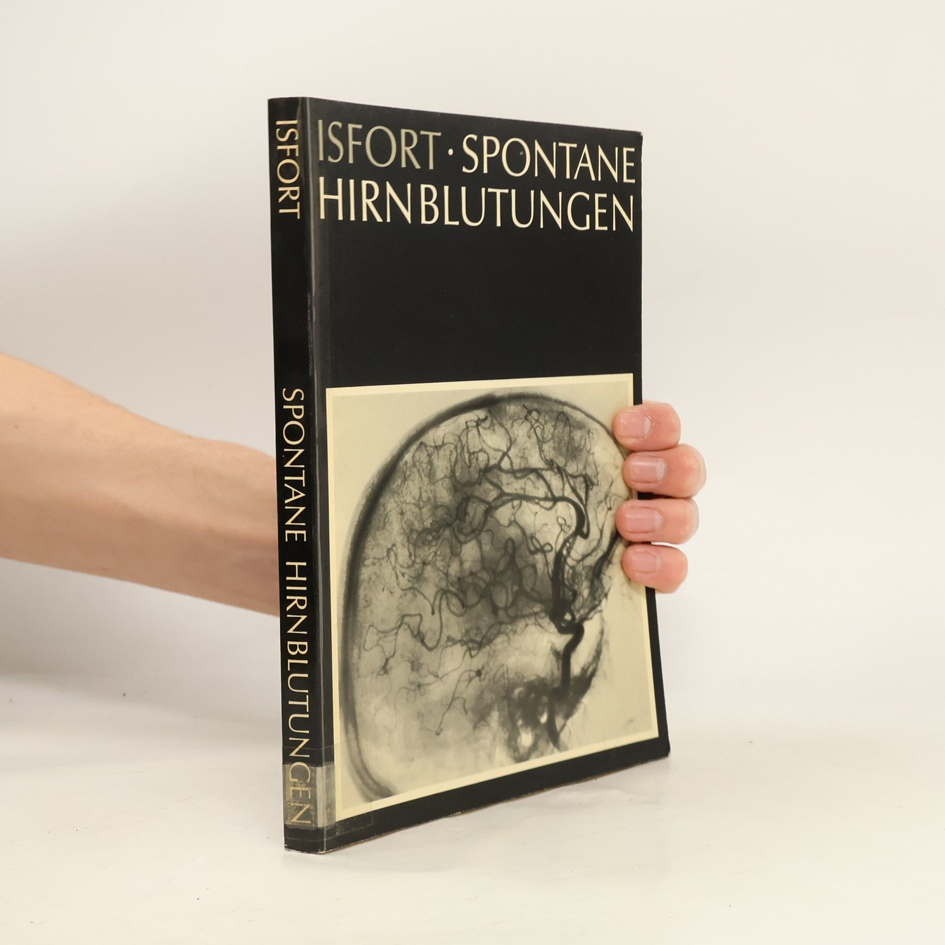 Alfons Isfort Spontane Hirnblutungen
