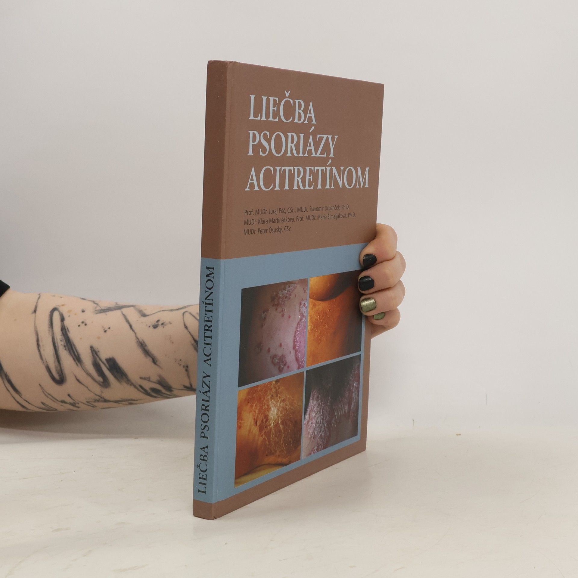 Juraj Péč Liečba psoriázy acitretínom