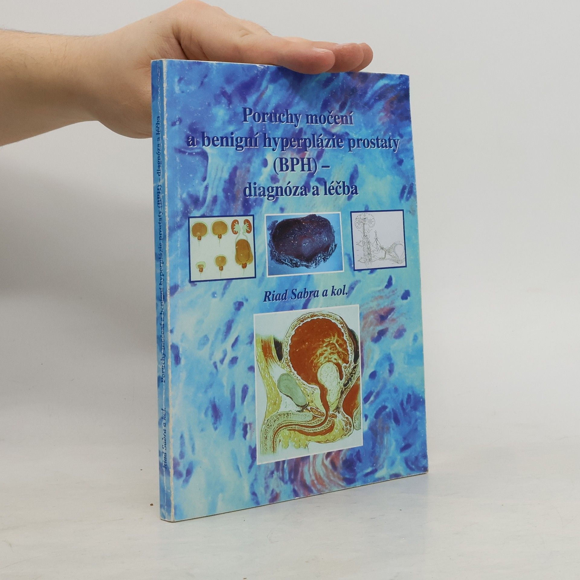 Poruchy močení a benigní hyperplázie prostaty (BPH) – diagnóza a léčba