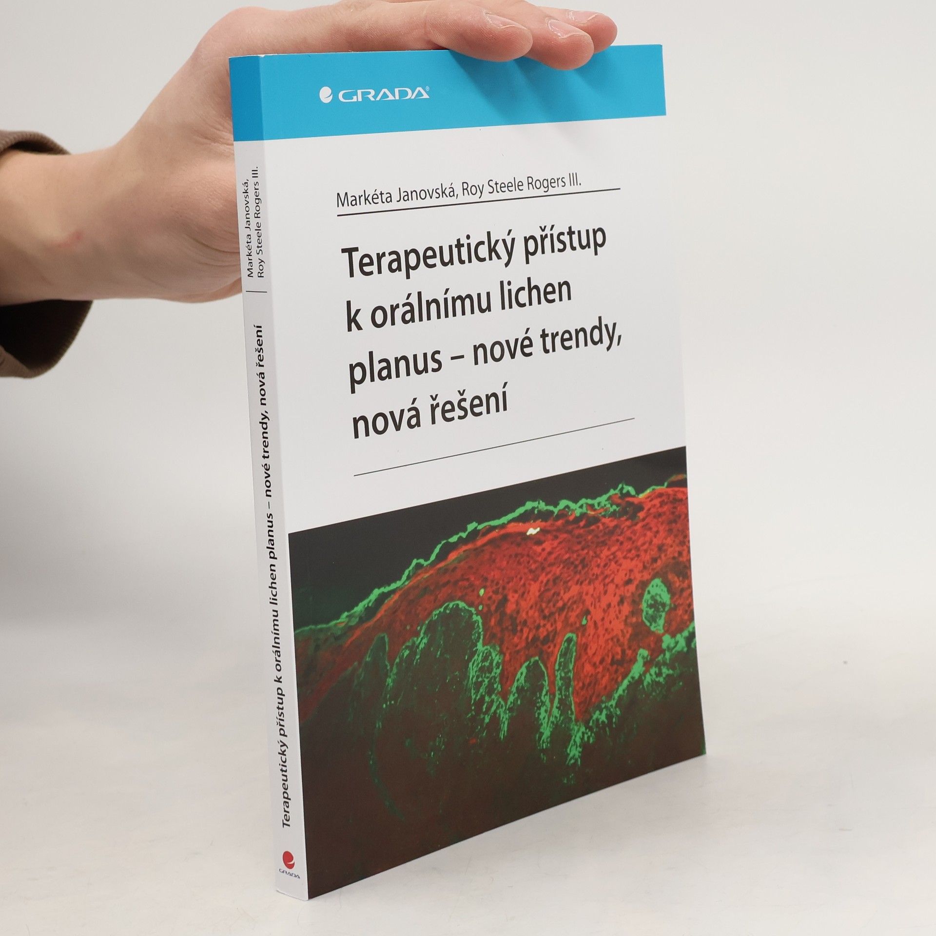 Markéta Janovská Terapeutický přístup k orálnímu lichen planus - nové trendy, nová řešení