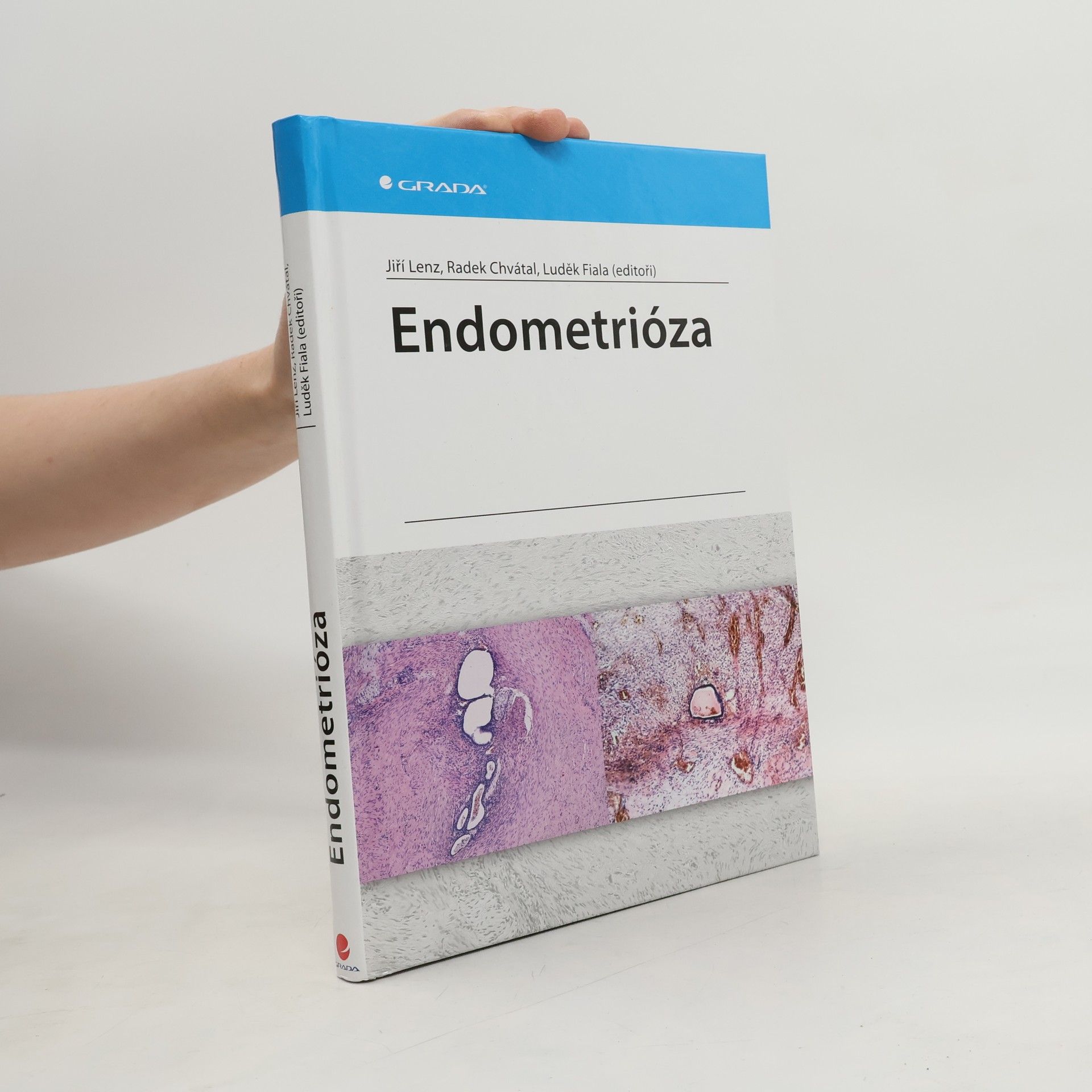 Endometrióza