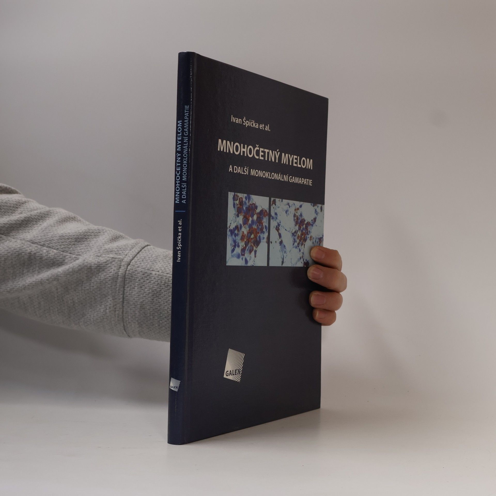 Mnohočetný myelom a další monoklonální gamapatie