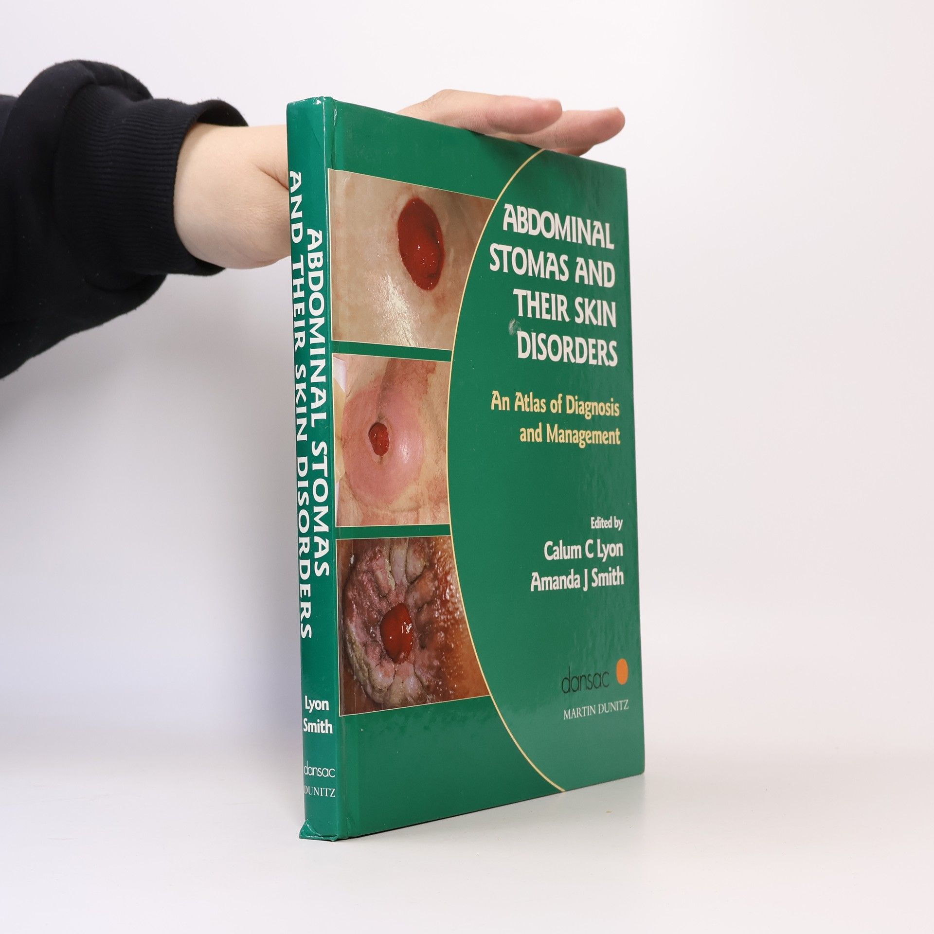 Calum C Lyon Abdominal Stomas and Their Skin Disorders