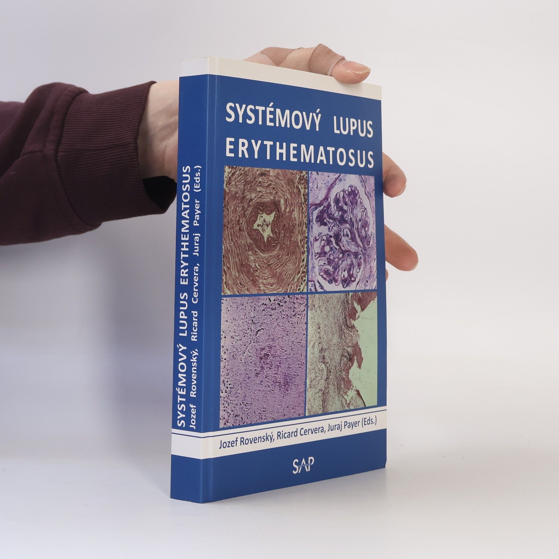 Systémový lupus erythematosus