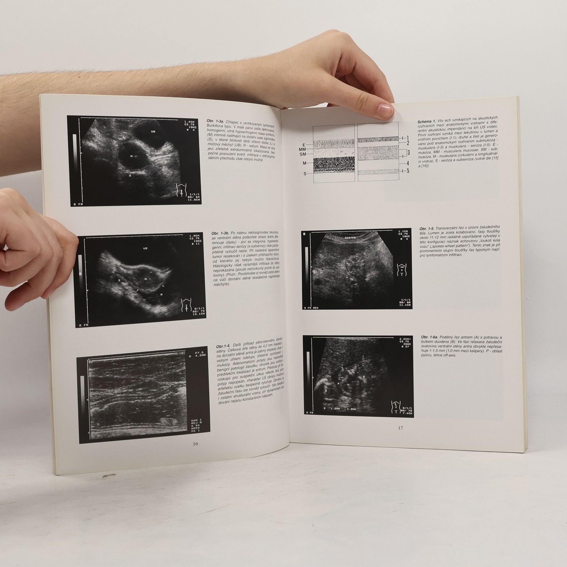 Václav Šimonovský Transabdominální sonografie trávicí trubice včetně sonografie akutní apendicitidy
