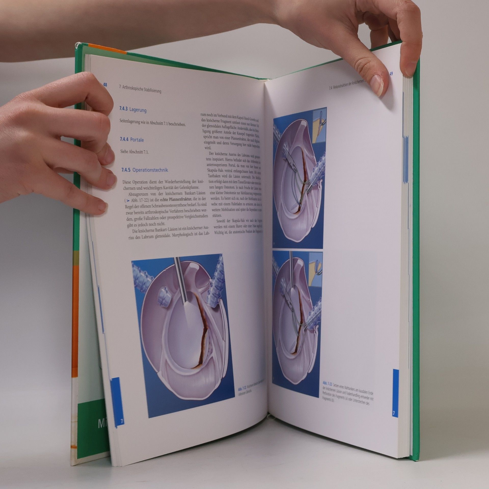 Sven Lichtenberg Atlas Schulterarthroskopie: Mit Zugang zum Elsevier-Portal: Mit dem Plus im Web