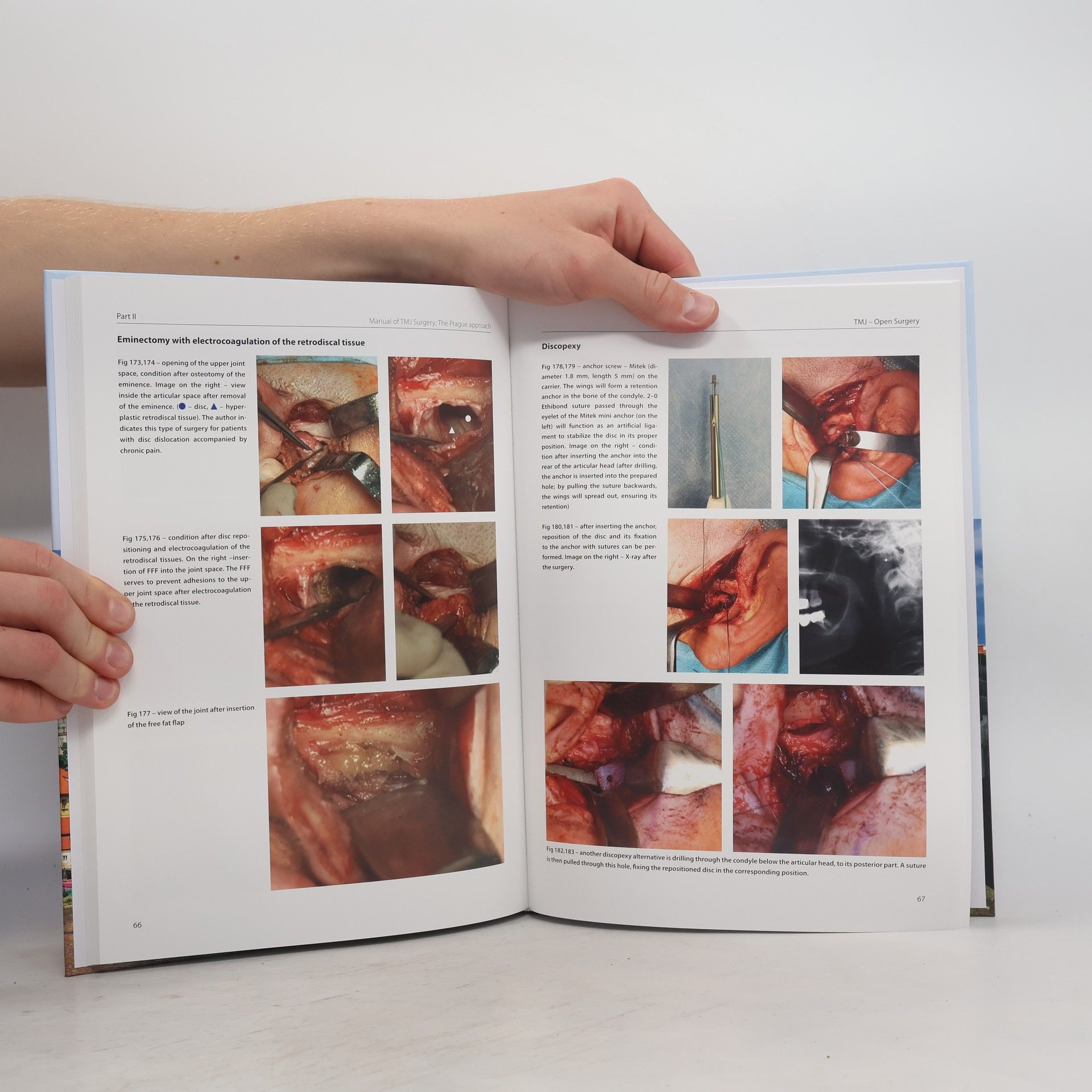 Vladimír Machoň Manual of TMJ surgery : the Prague approach