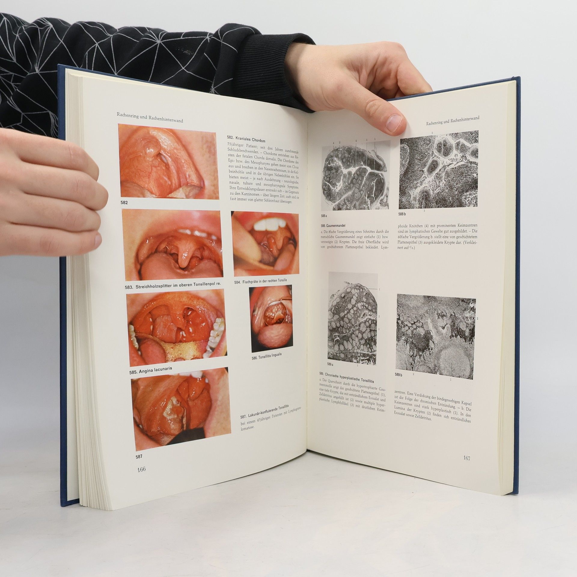 Kolektiv autorů Atlas der Hals-Nasen-Ohren-Krankheiten einschliesslich Bronchien und Ösophagus