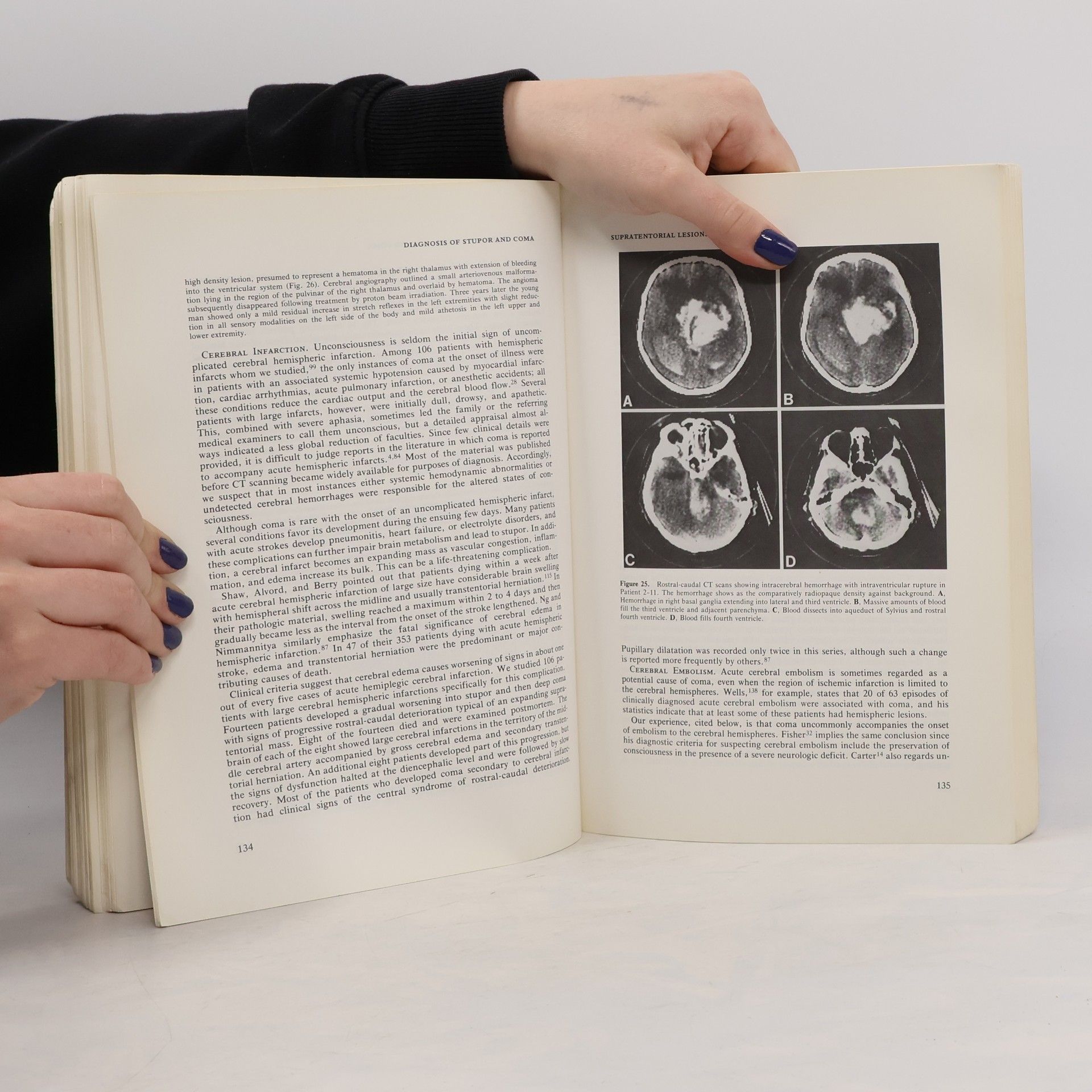 Fred Gordon Plummer The Diagnosis of Stupor and Coma