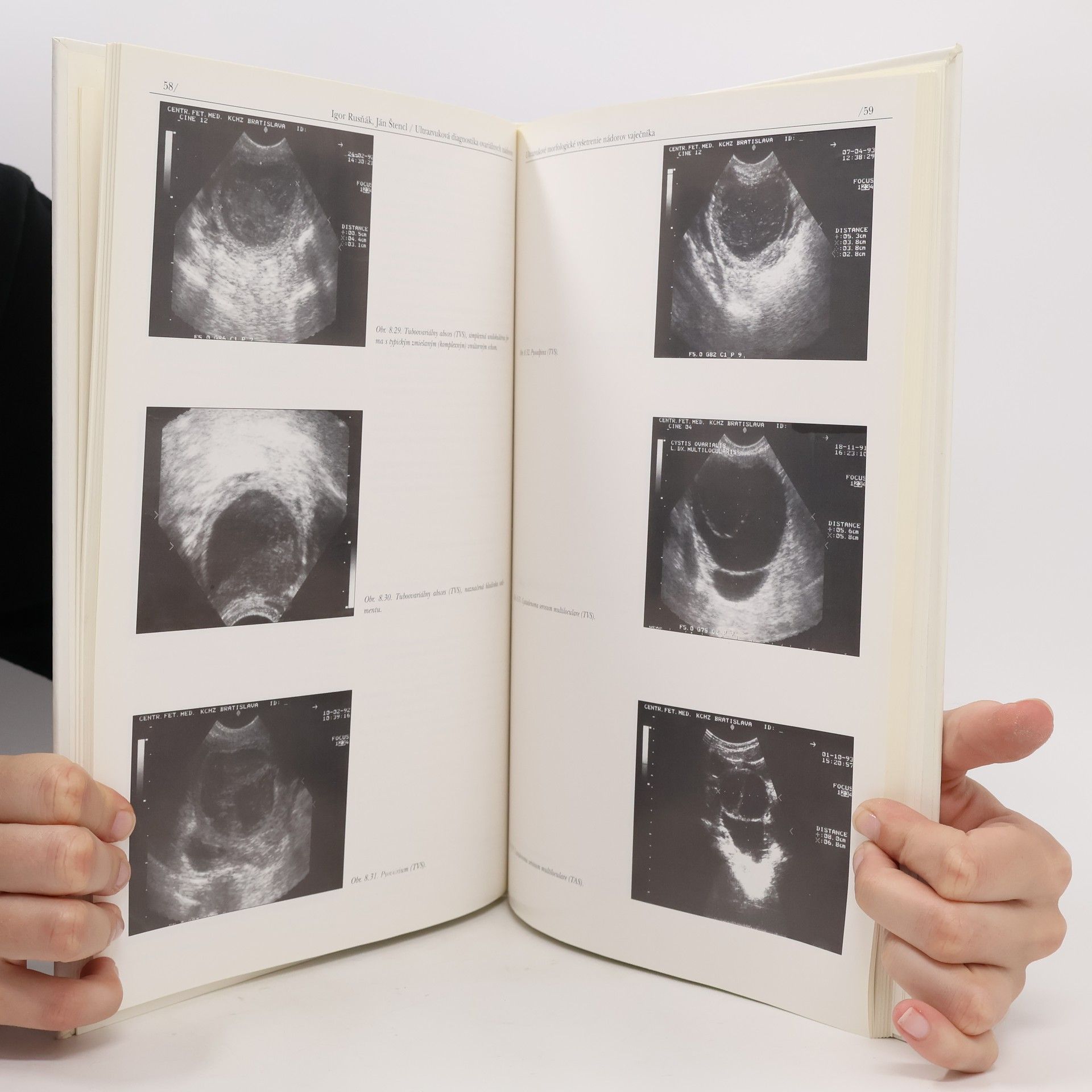 Igor Rusňák Ultrazvuková diagnostika ovariálnych nádorov