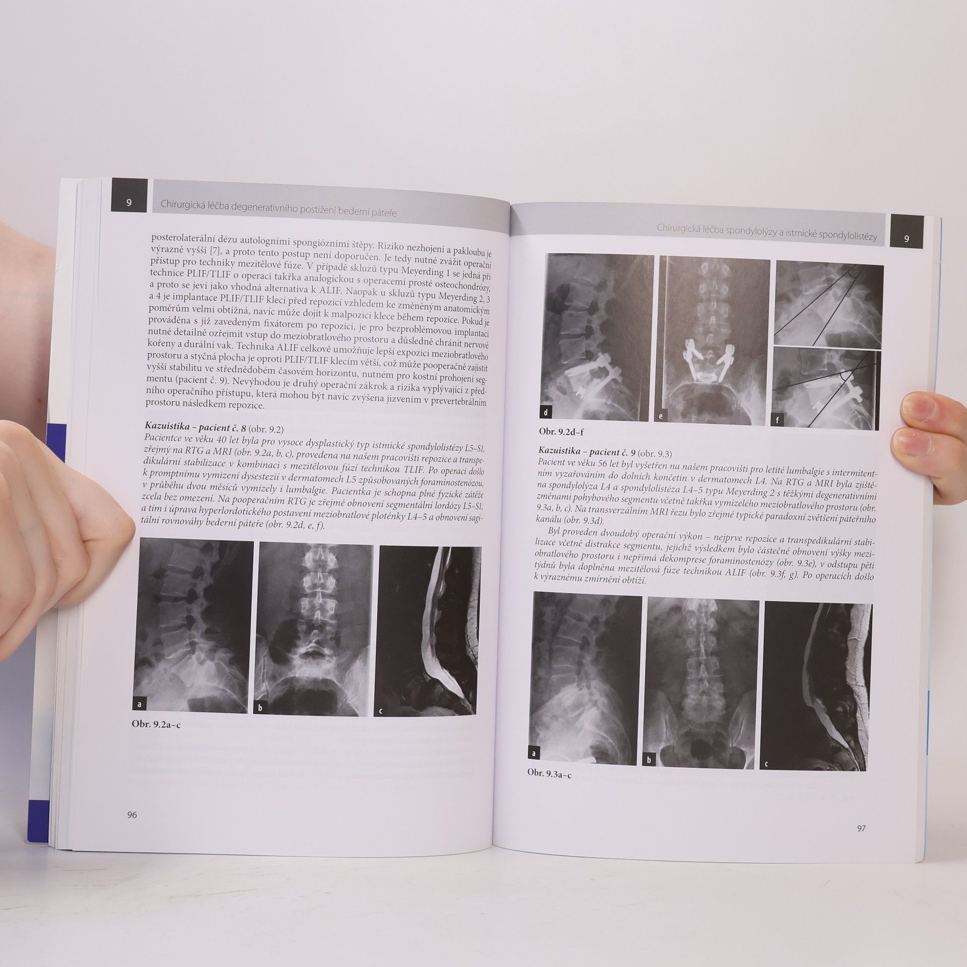 Jiří Šrámek Chirurgická léčba degenerativního postižení bederní páteře