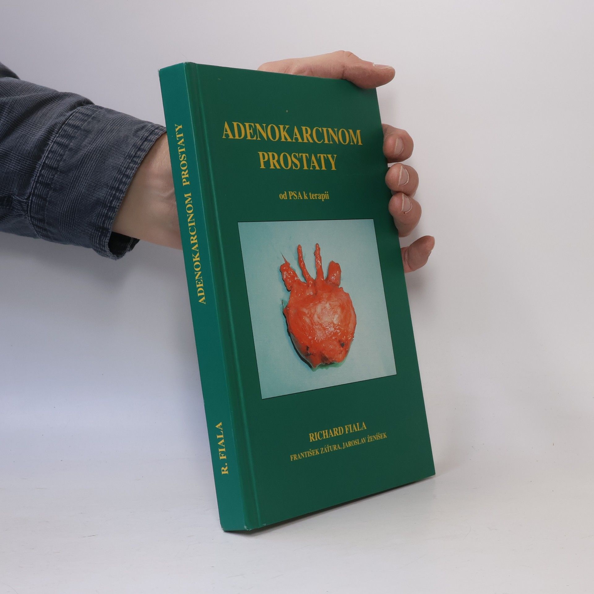 Adenokarcinom prostaty od PSA k terapii