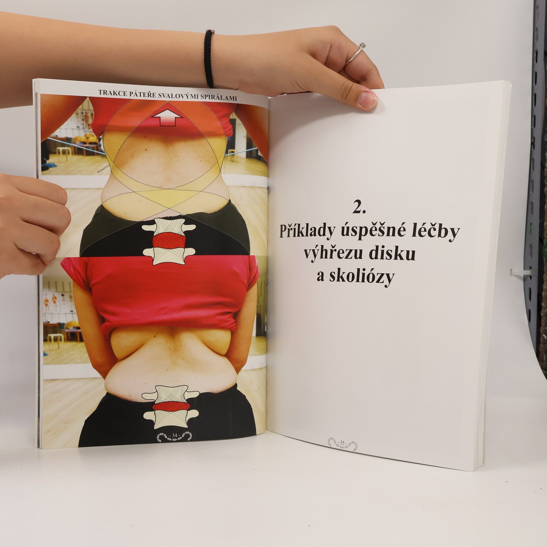 Richard Smíšek Spirální stabilizace páteře: léčba výhřezu meziobratlového disku a skoliózy