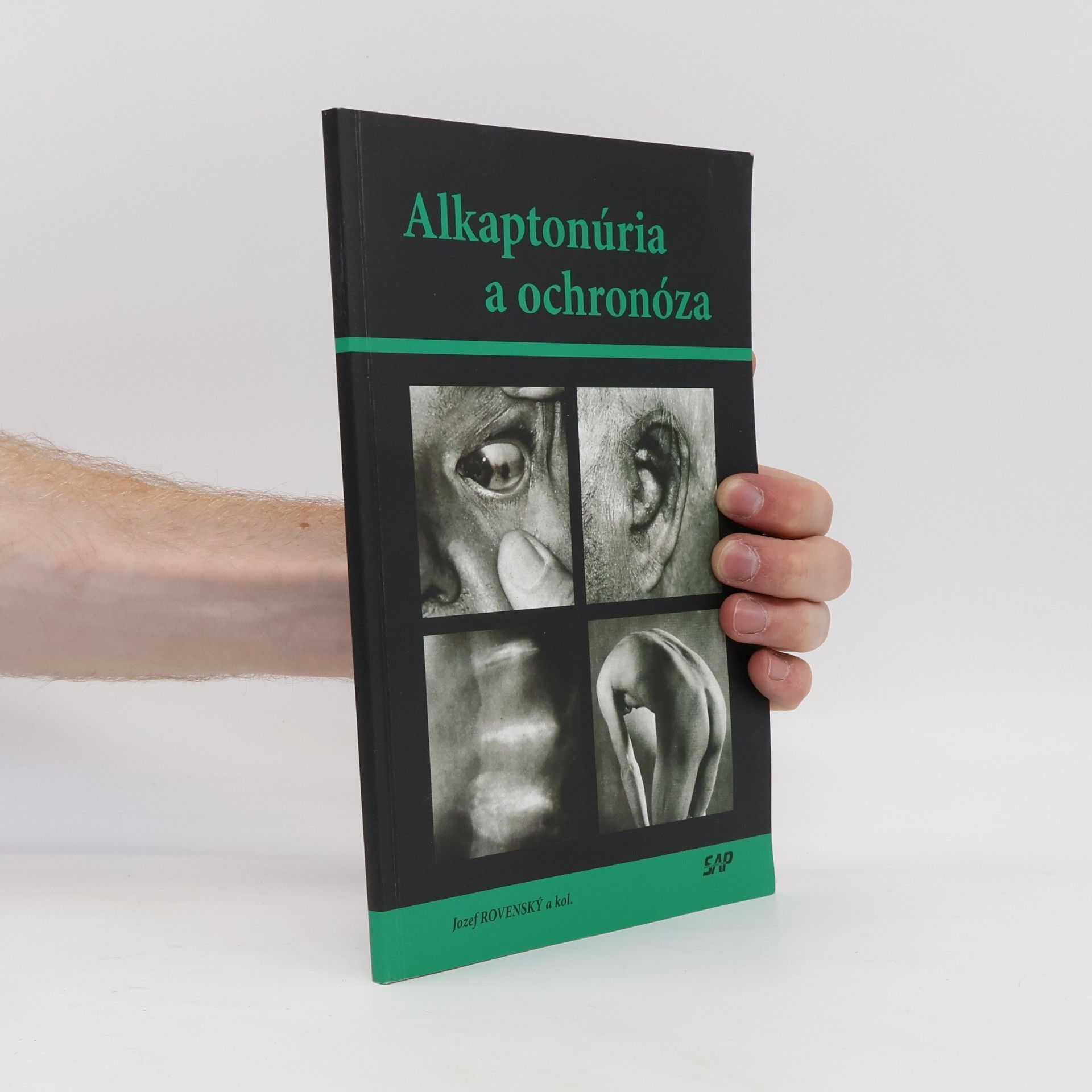 Jozef Rovenský Alkaptonúria a ochronóza