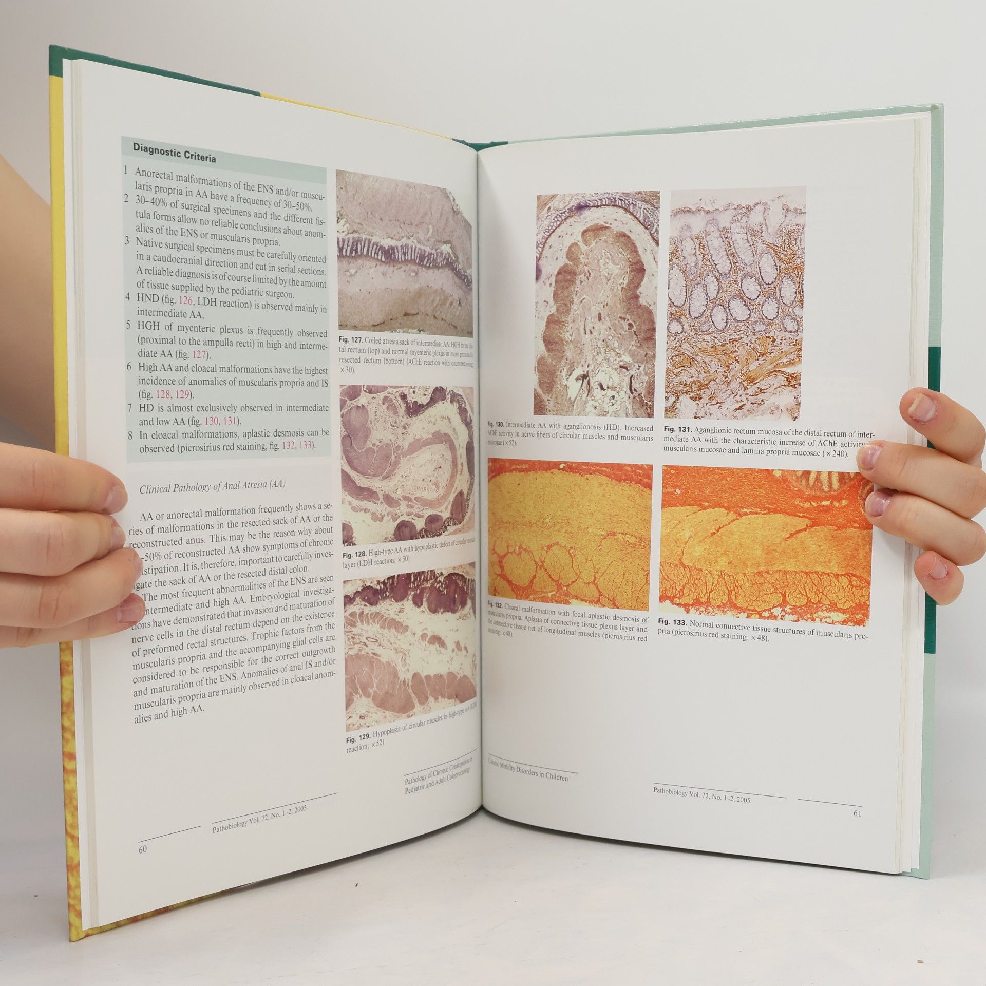 William A. Meier-Ruge Pathology of Chronic Constipation in Pediatric and Adult Coloproctology