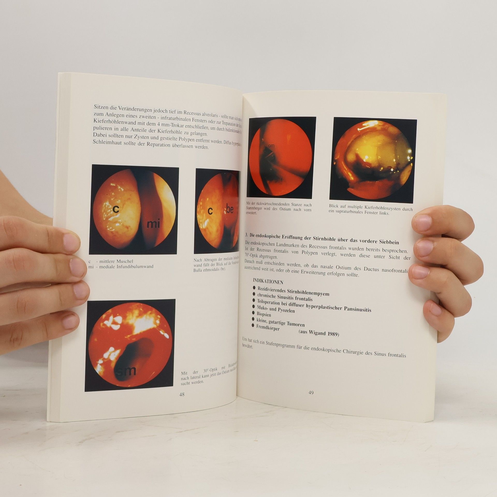 Hans Behrbohm Die minimal invasive endoskopische Chirurgie der Nase und der Nasennebebenhöhlen