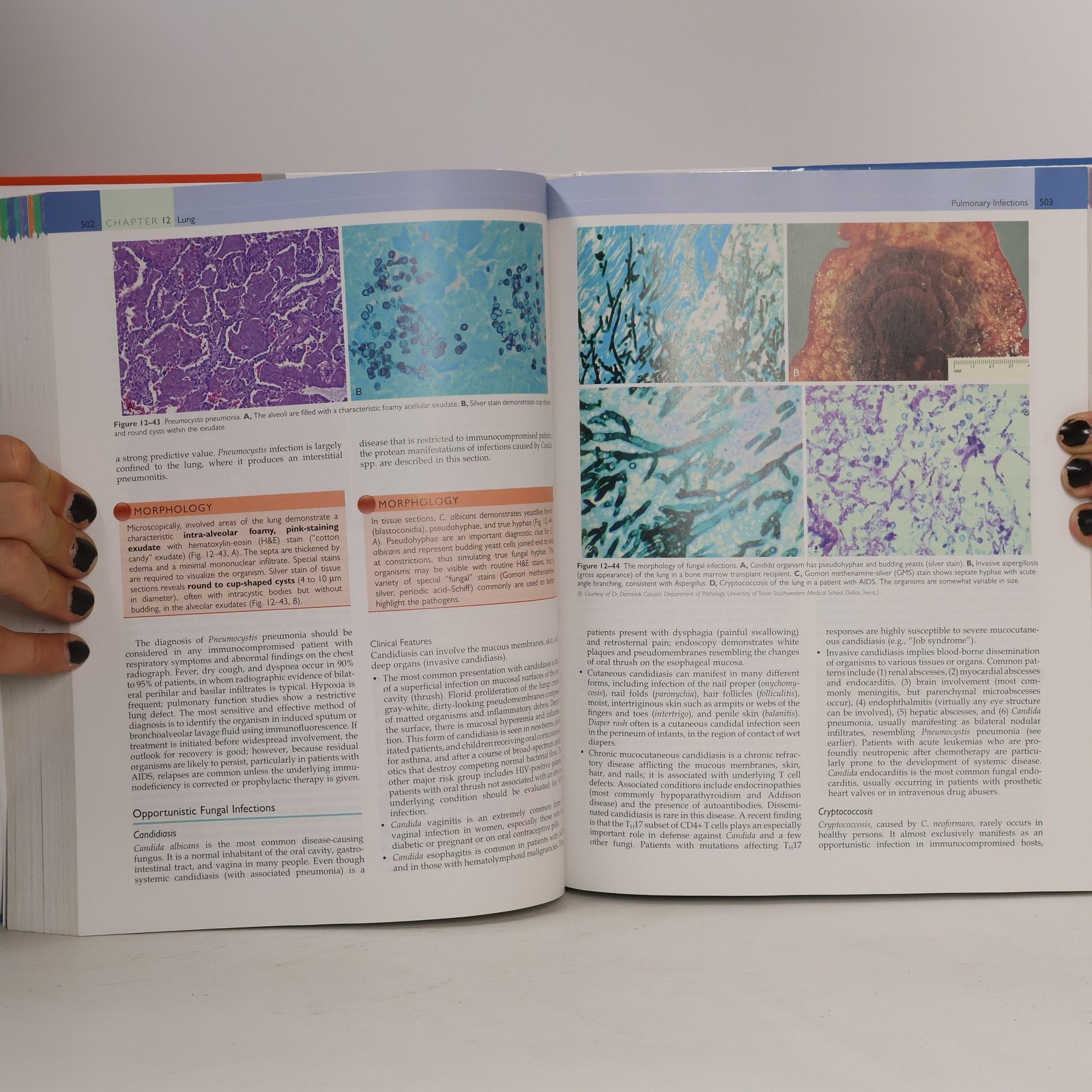 Viay Kumar Robbins basic pathology