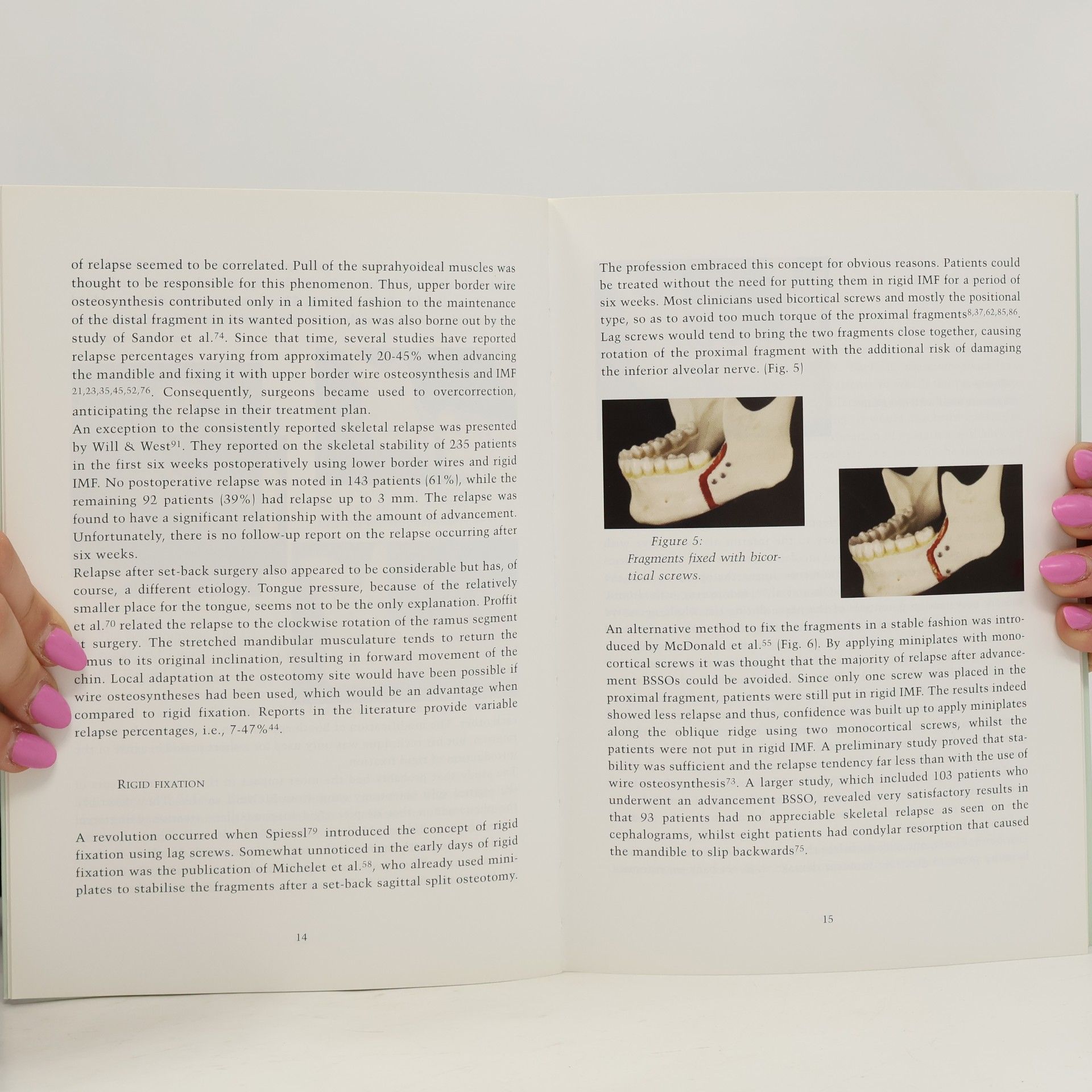 Wilfried Ary Borstlap The Fixation of Sagittal Split Osteotomies with Miniplates