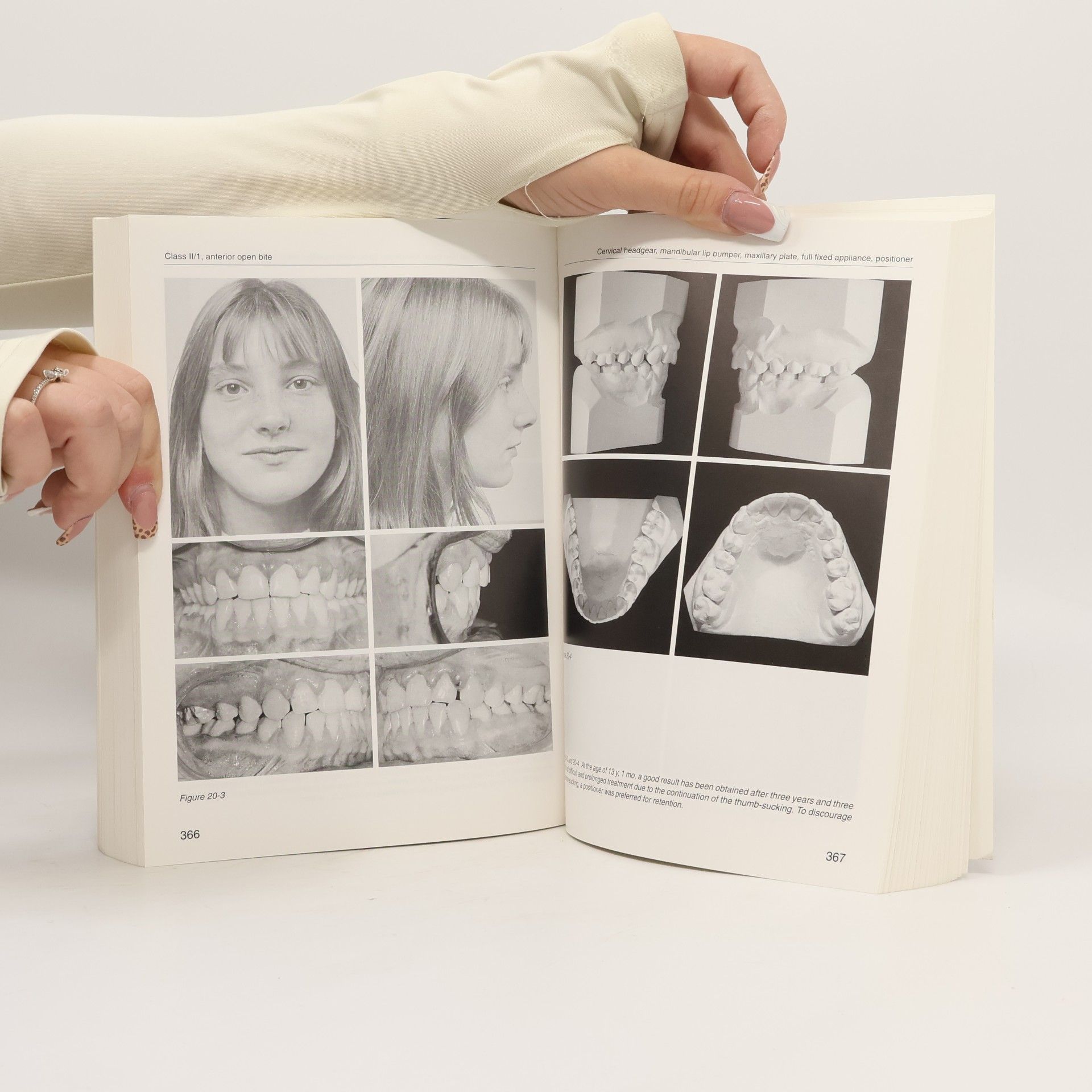 Frans P. G. M. van der Linden Van Der Linden Series - 6: Orthodontics With Fixed Appliances
