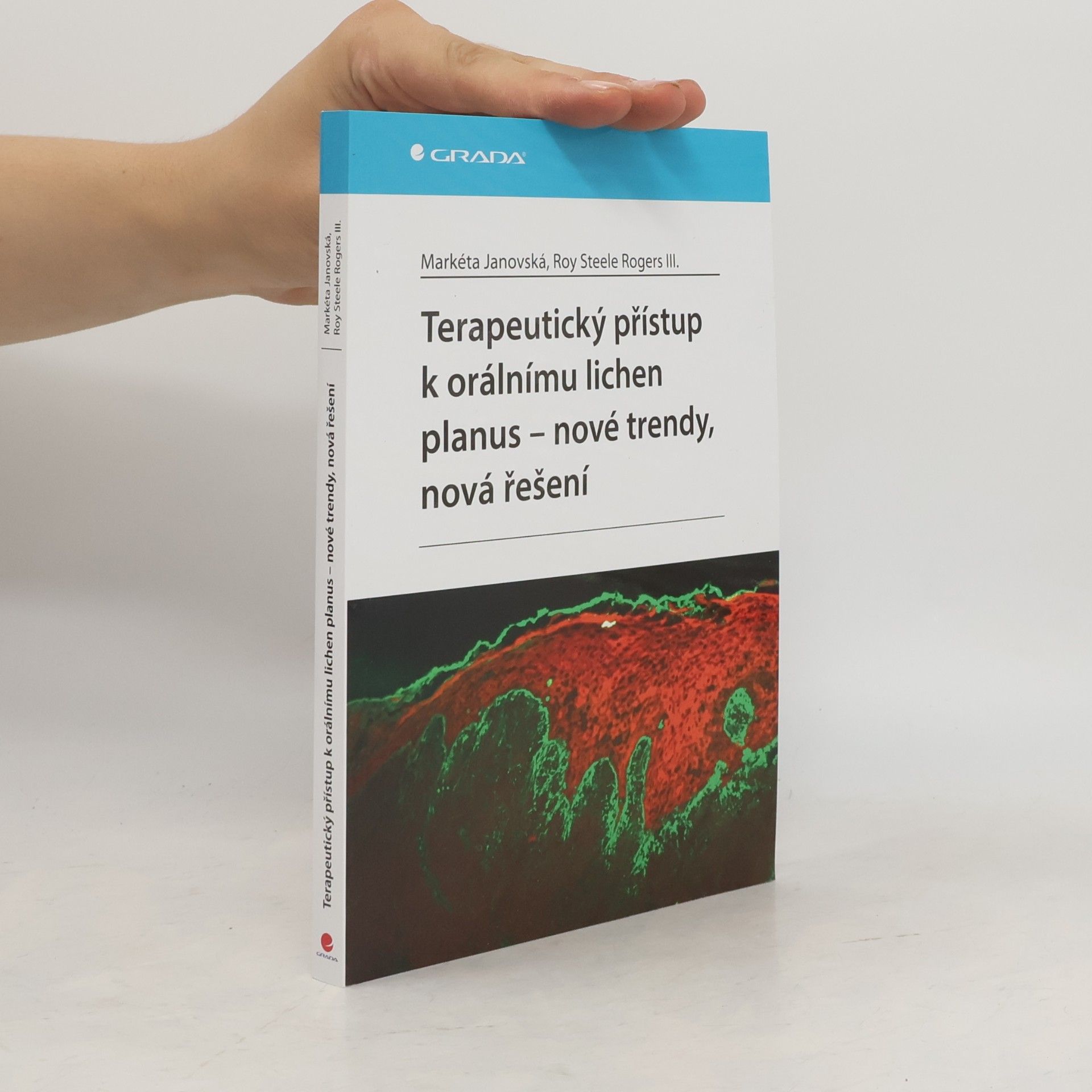 Markéta Janovská Terapeutický přístup k orálnímu lichen planus - nové trendy, nová řešení