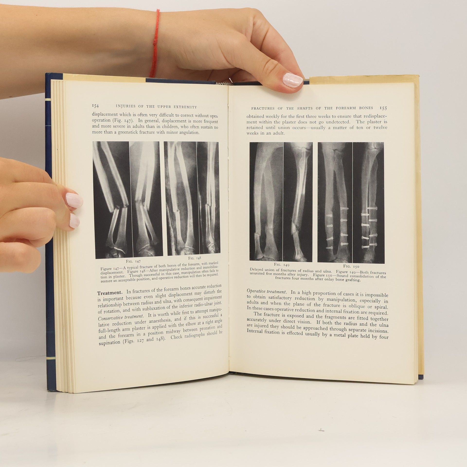John Crawford Adams Outline of Fractures, Including Joint Injuries - Sixth Edition