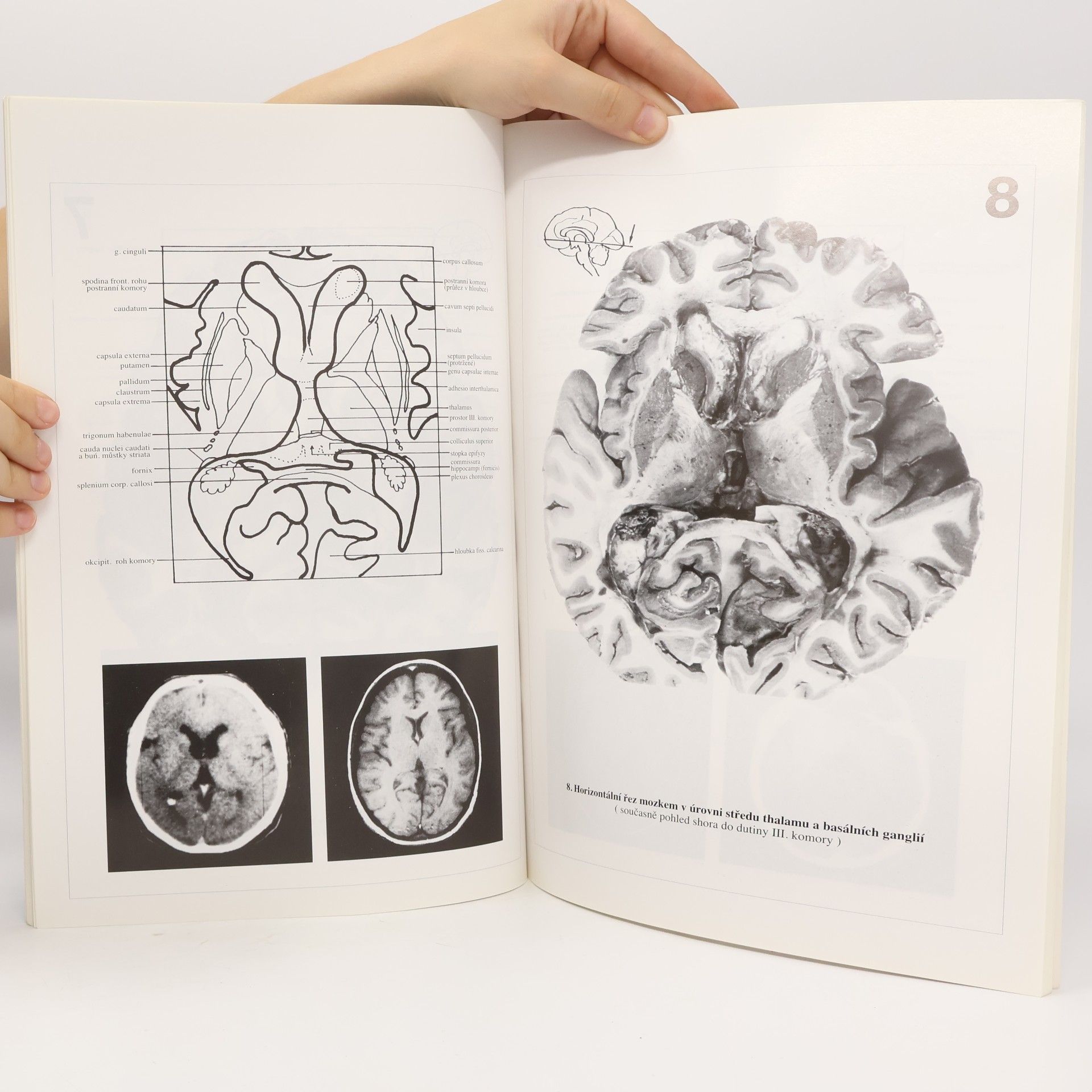 Pavel Petrovický Řezy mozkem : Neuroanatomie, CT, NMR