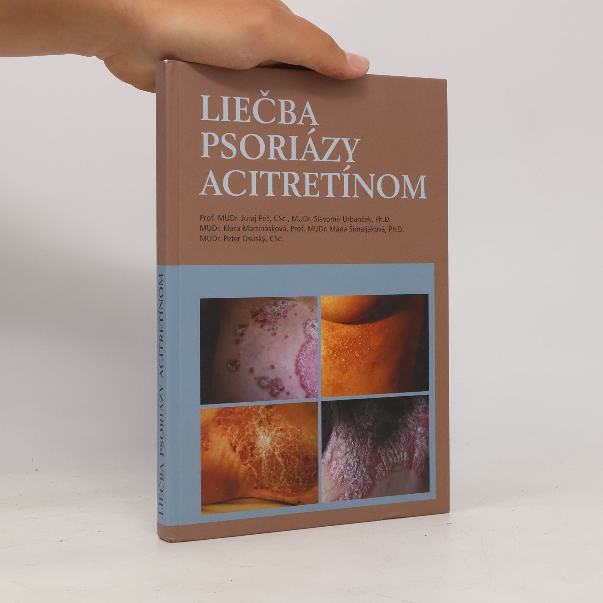 Juraj Péč Liečba psoriázy acitretínom