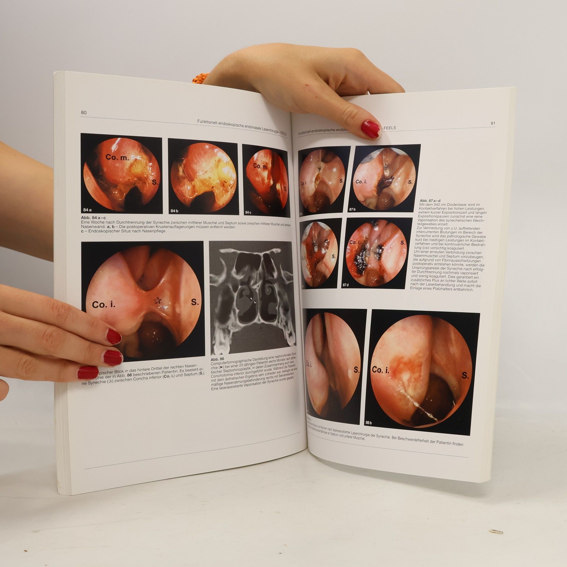 Jürgen U. G. Hopf Funtionell-endoskopische endonasale Laserchirurgie