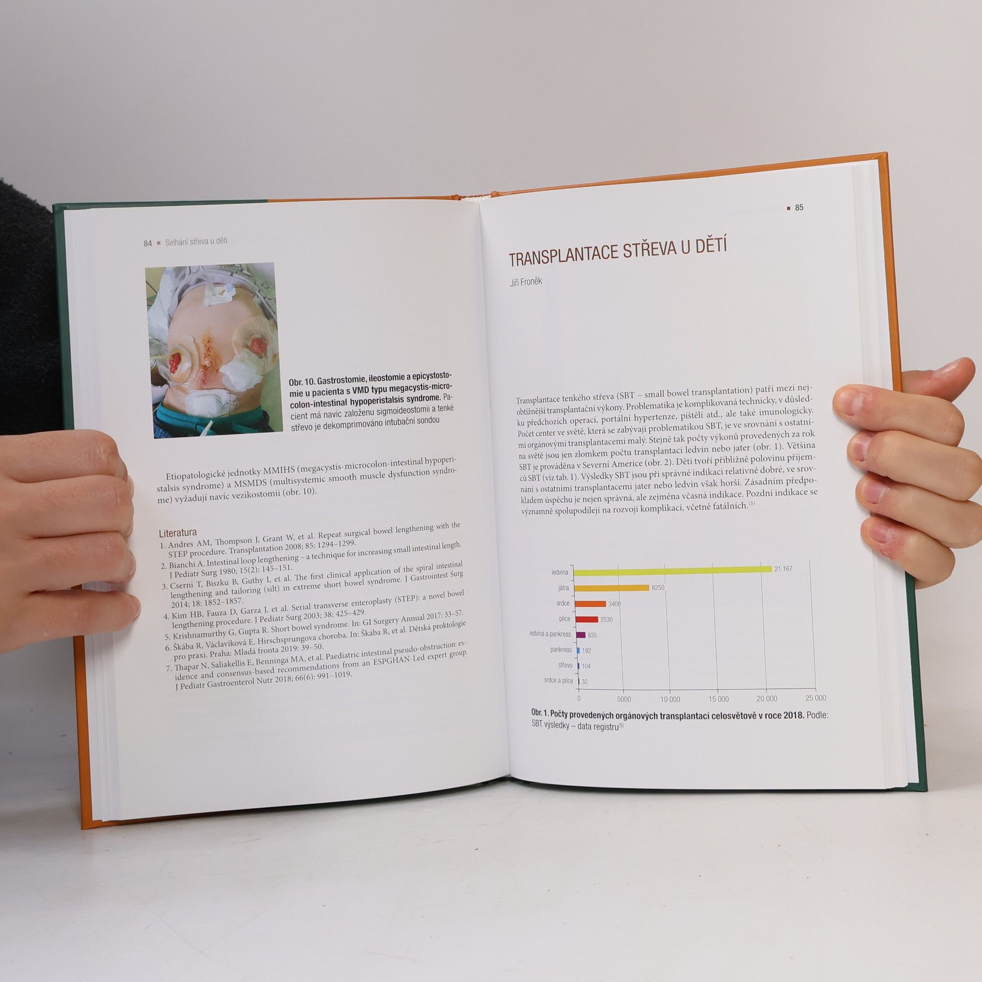 Autores varios Selhání střeva u dětí / Etiopatogeneze a terapie