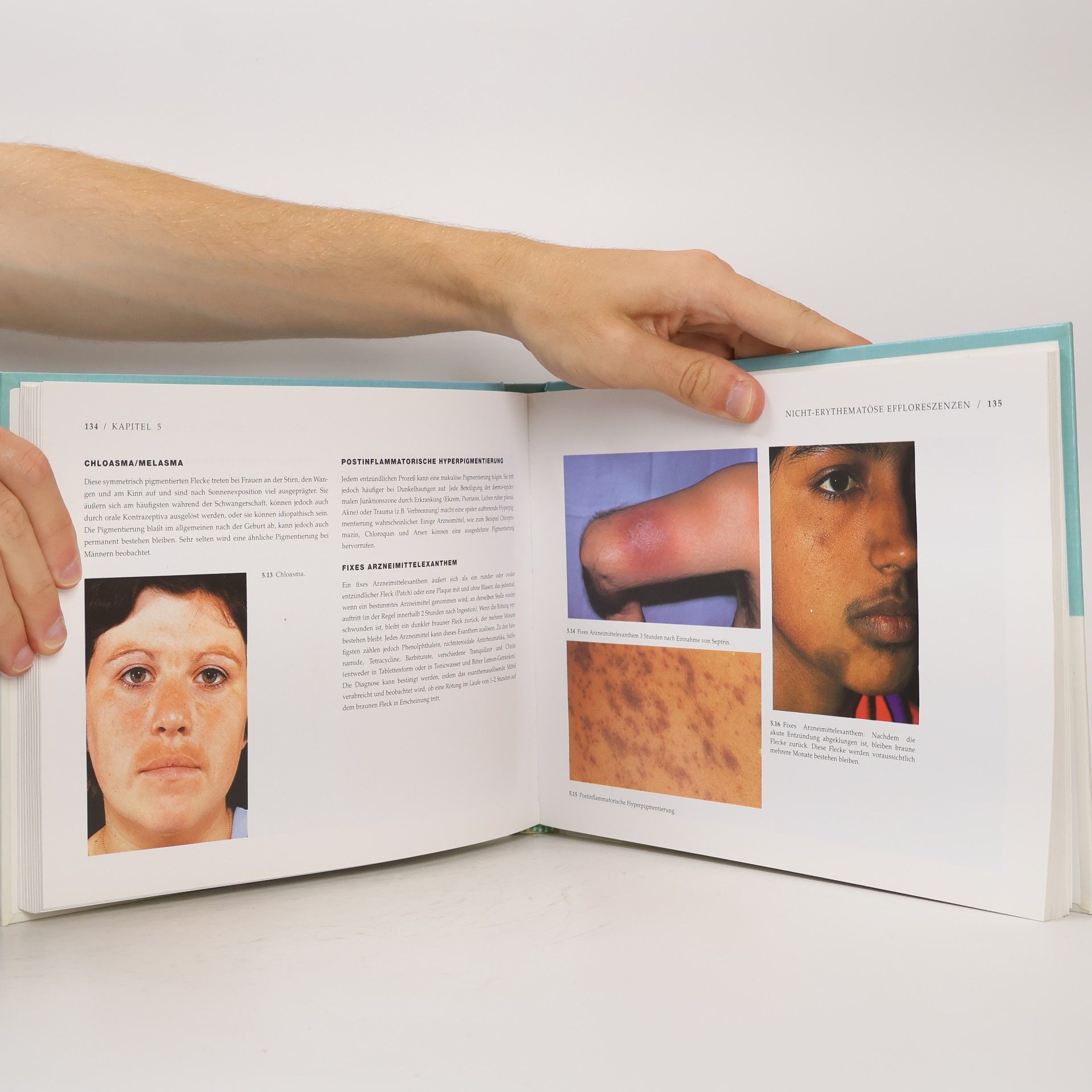 Richard Ashton Differential Diagnosis In Dermatology