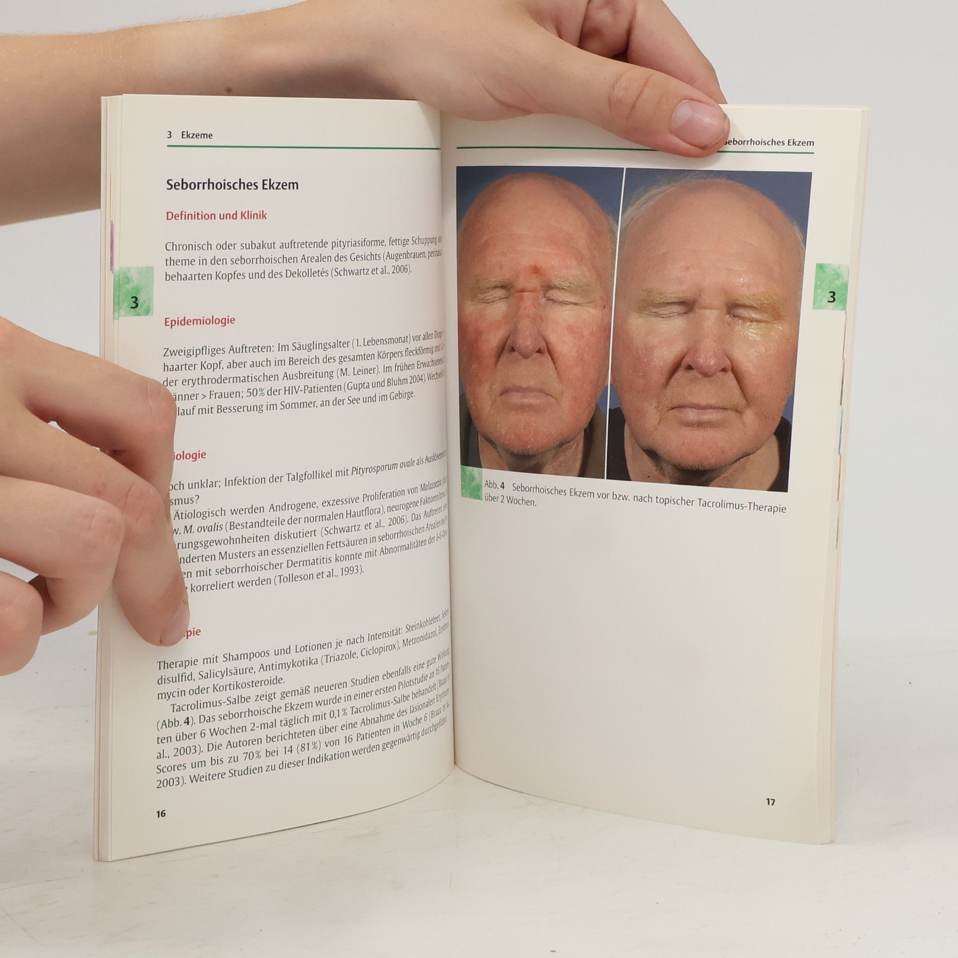 Ulrich R. Hengge Spezielle Behandlungsoptionen mit topischem Tacrolimus: Taschenatlas spezial