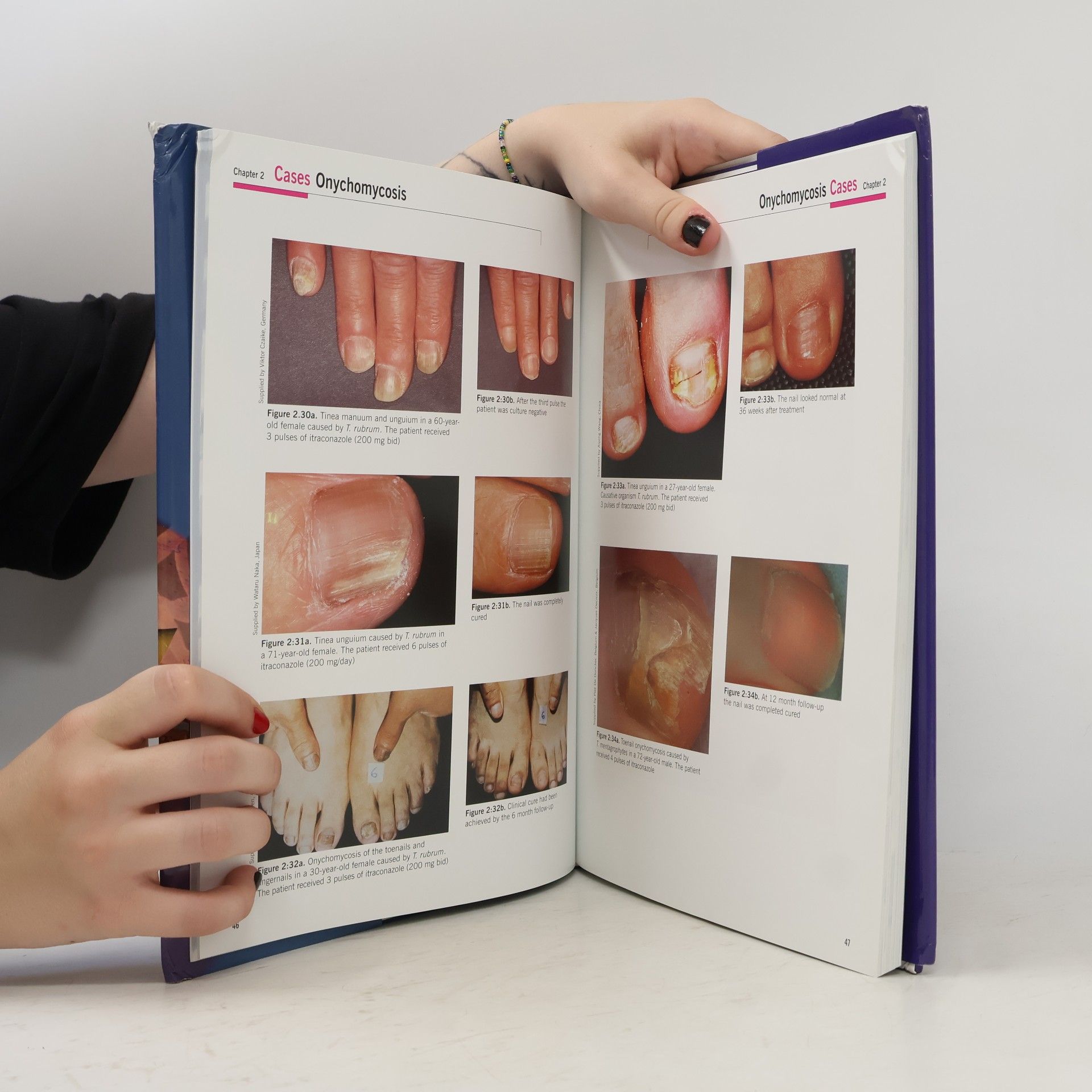 Hugo Degreef Fighting Fungal Infections Around the Globe: Itraconazole in Perspective