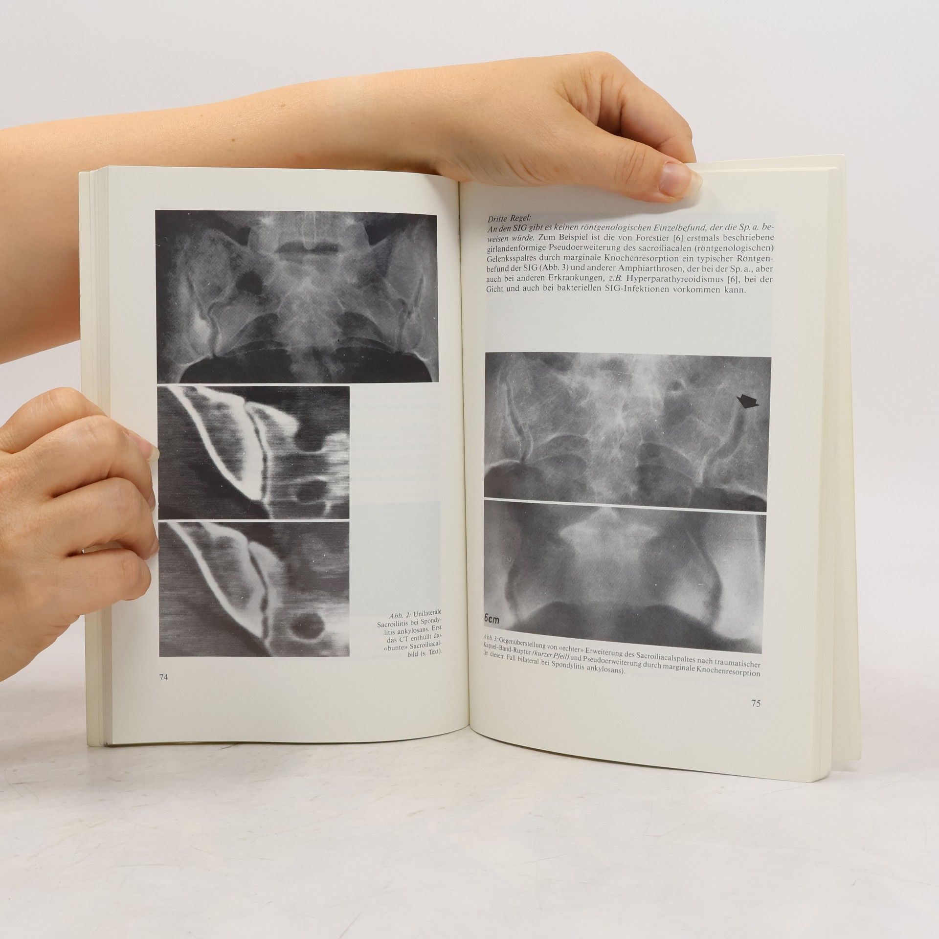 Niklaus Fellmann Spondylitis ankylosans, Morbus Bechterew