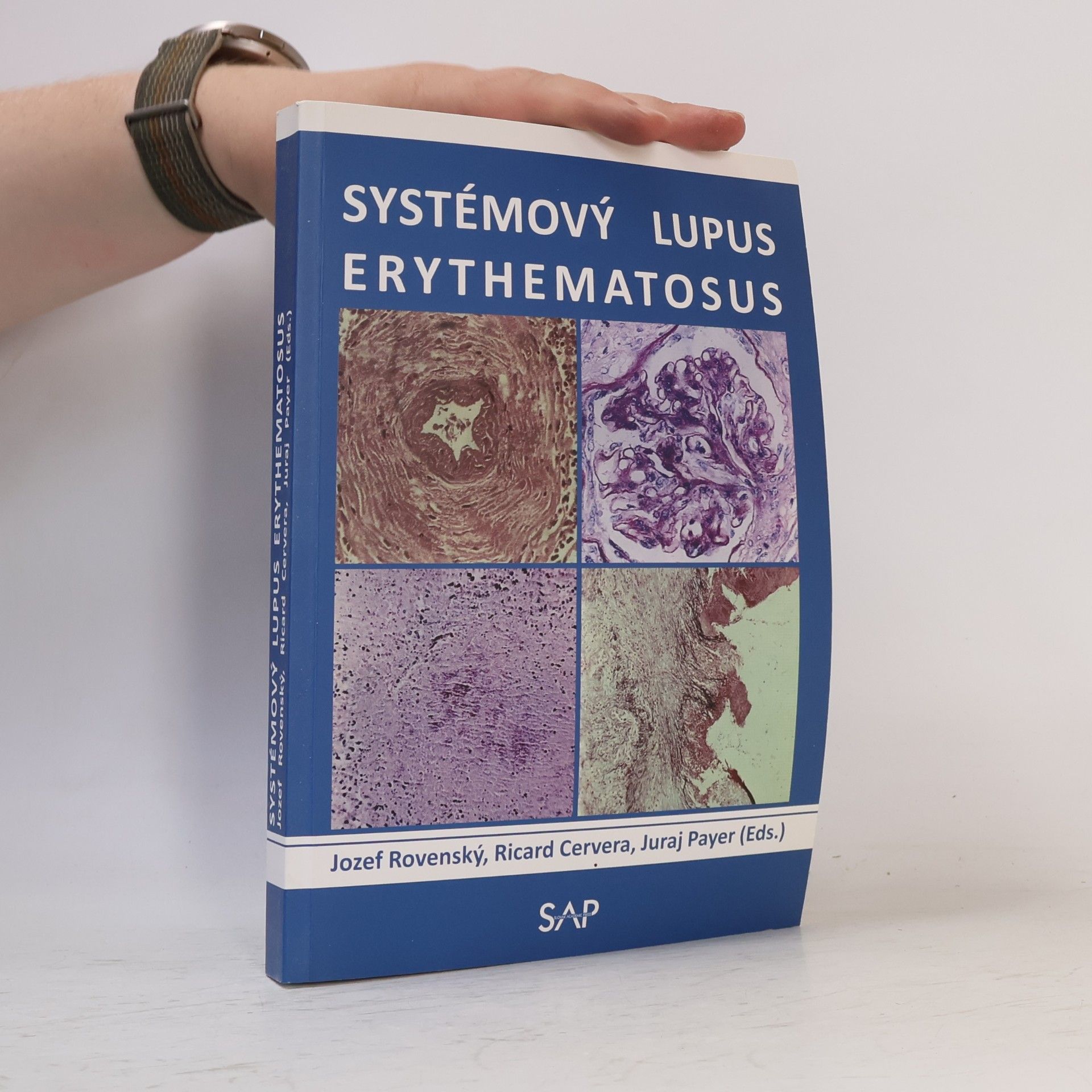 Ricard Cervera Systémový lupus erythematosus