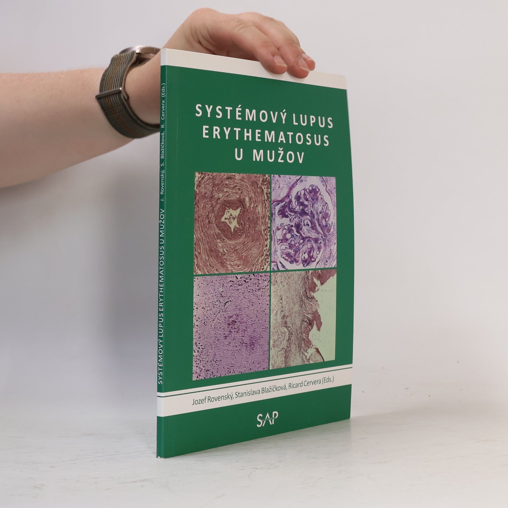 Systemovy lupus erythematosus u muzov