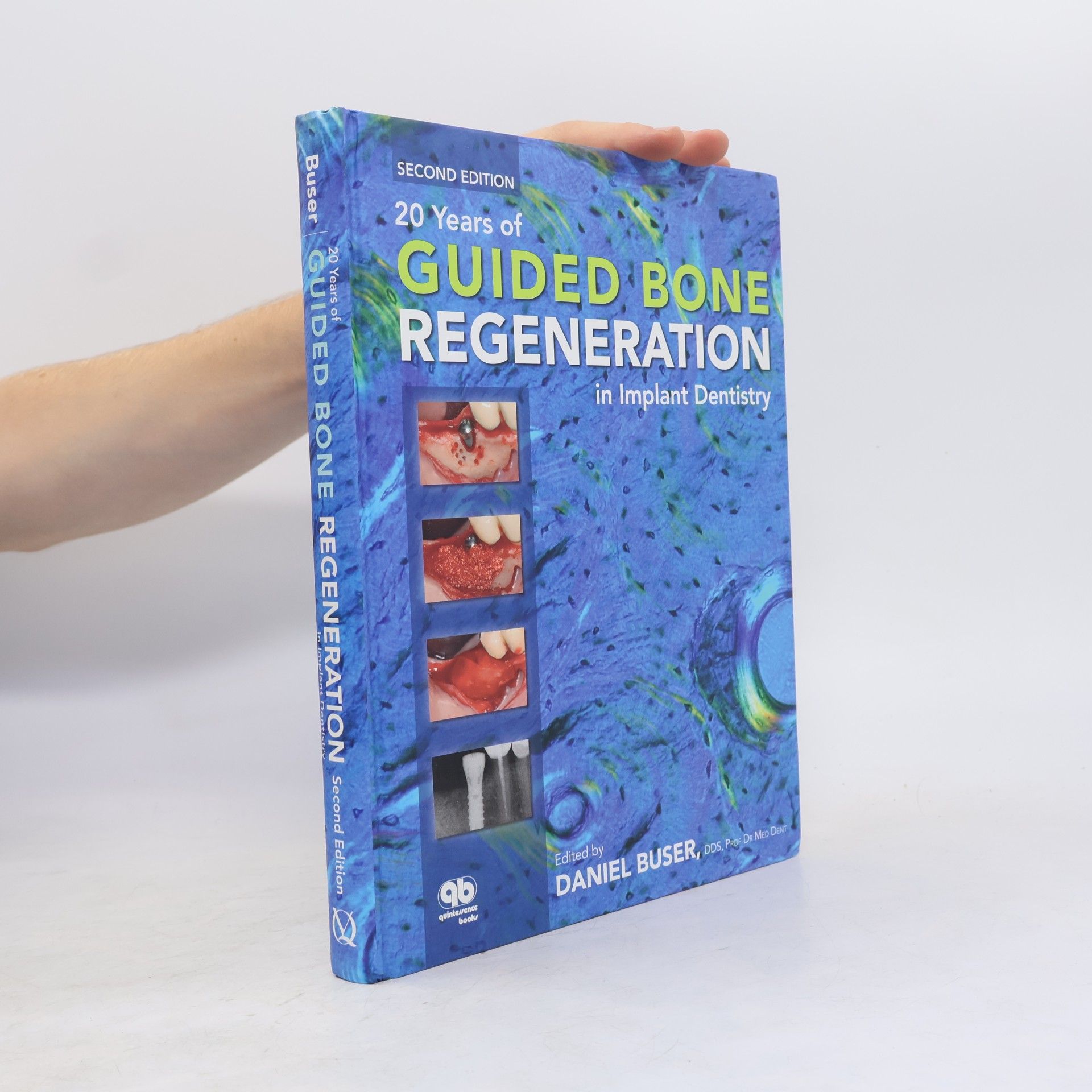 Daniel Buser 20 Years of Guided Bone Regeneration in Implant Dentistry